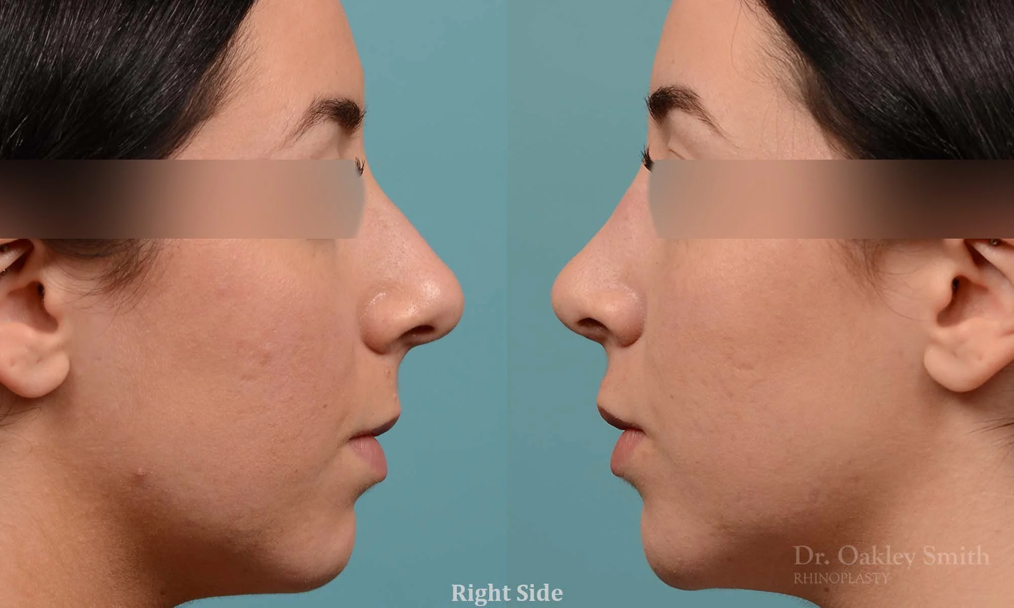 283C-rhinoplasty-dr-oakley-smith-toronto-nose-job (1).jpg
