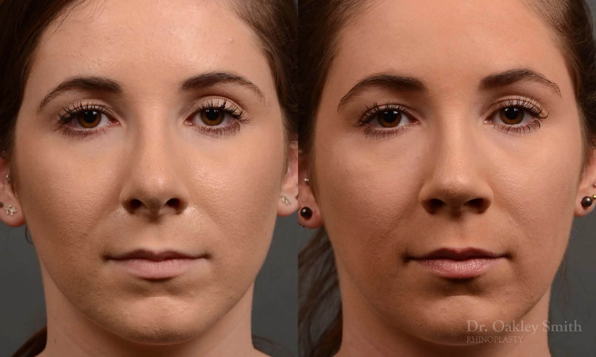 366A-rhinoplasty-dr-oakley-smith-toronto-nose-job.jpg