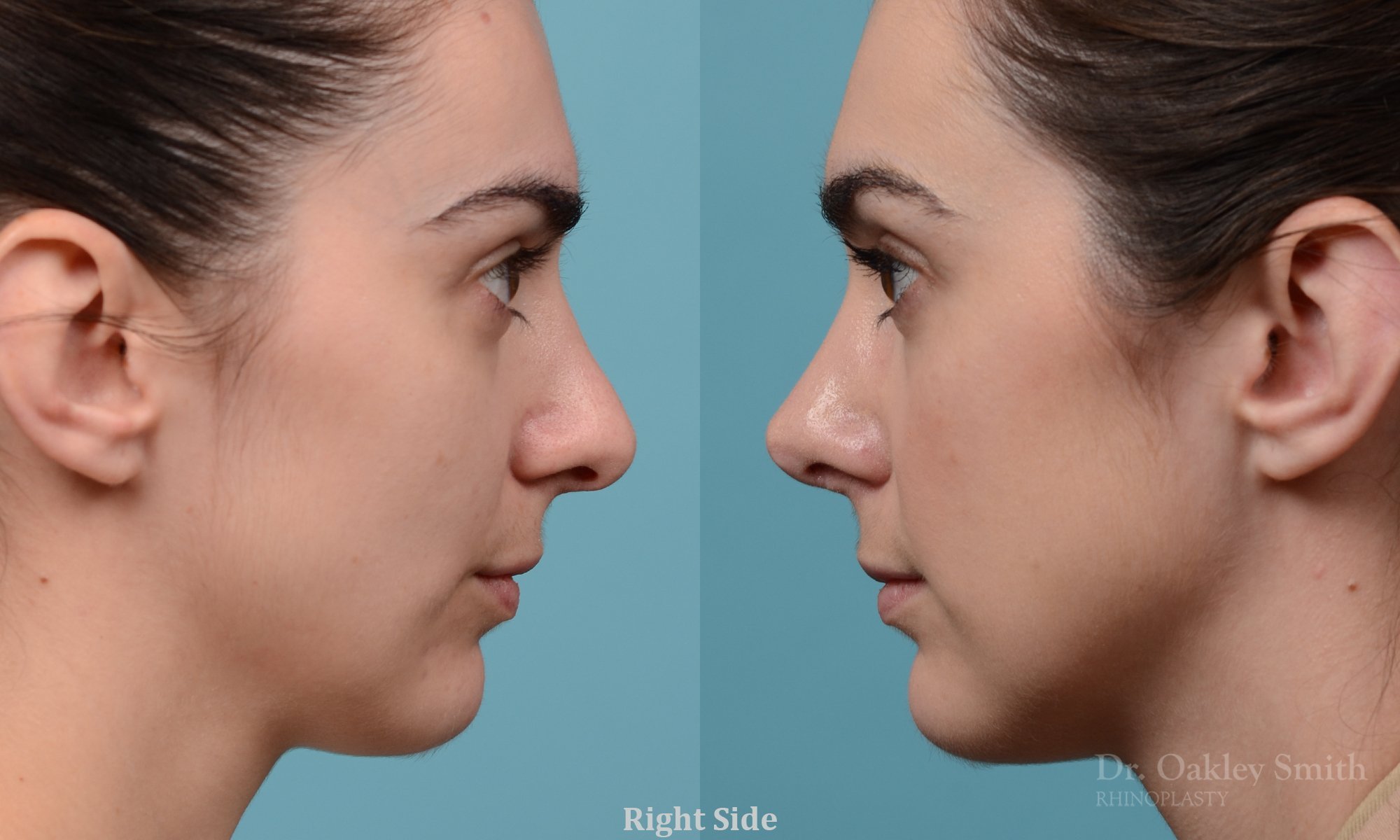 288C-rhinoplasty-dr-oakley-smith-toronto-nose-job (1).jpg