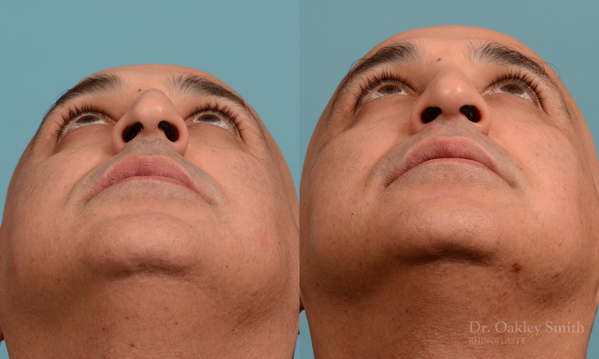 349.1F-rhinoplasty-dr-oakley-smith-toronto-nose-job.jpg