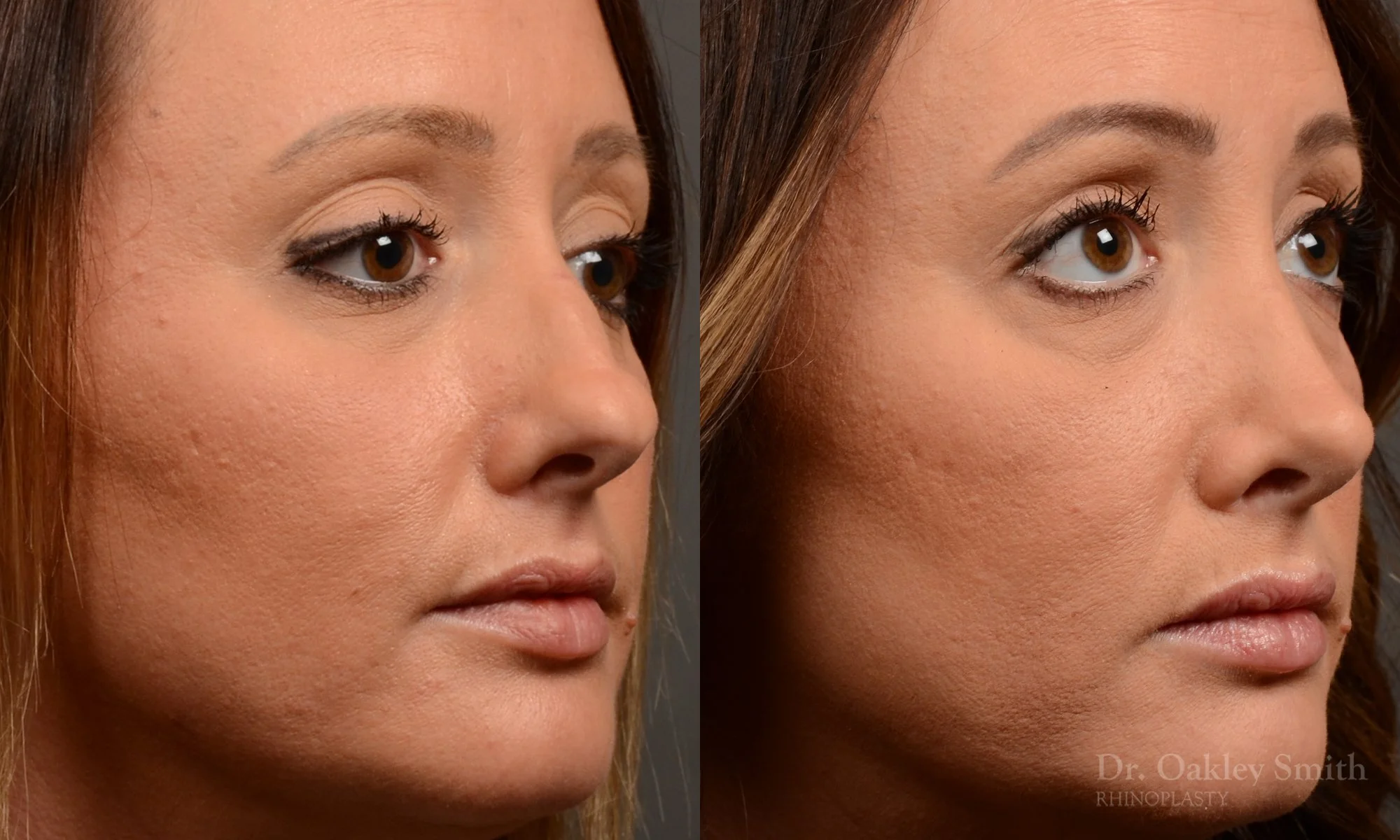 499B-rhinoplasty-dr-oakley-smith-toronto-top-surgeon-nose-job.jpg