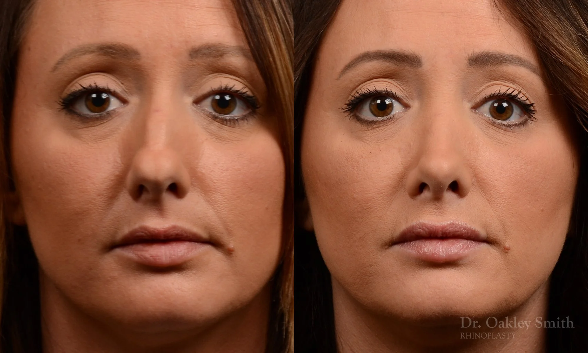 499A-rhinoplasty-dr-oakley-smith-toronto-top-surgeon-nose-job.jpg