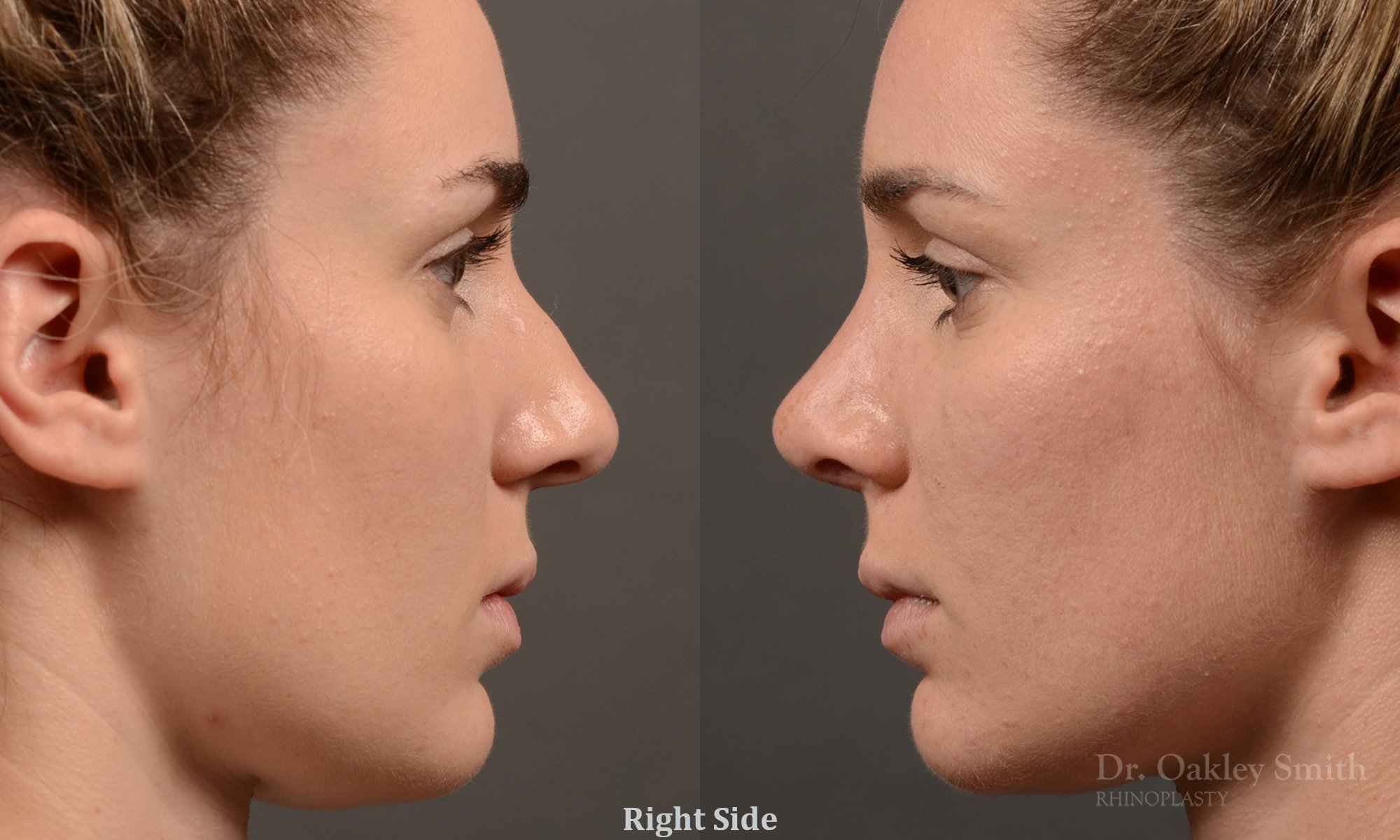 358C-rhinoplasty-dr-oakley-smith-toronto-nose-job.jpg