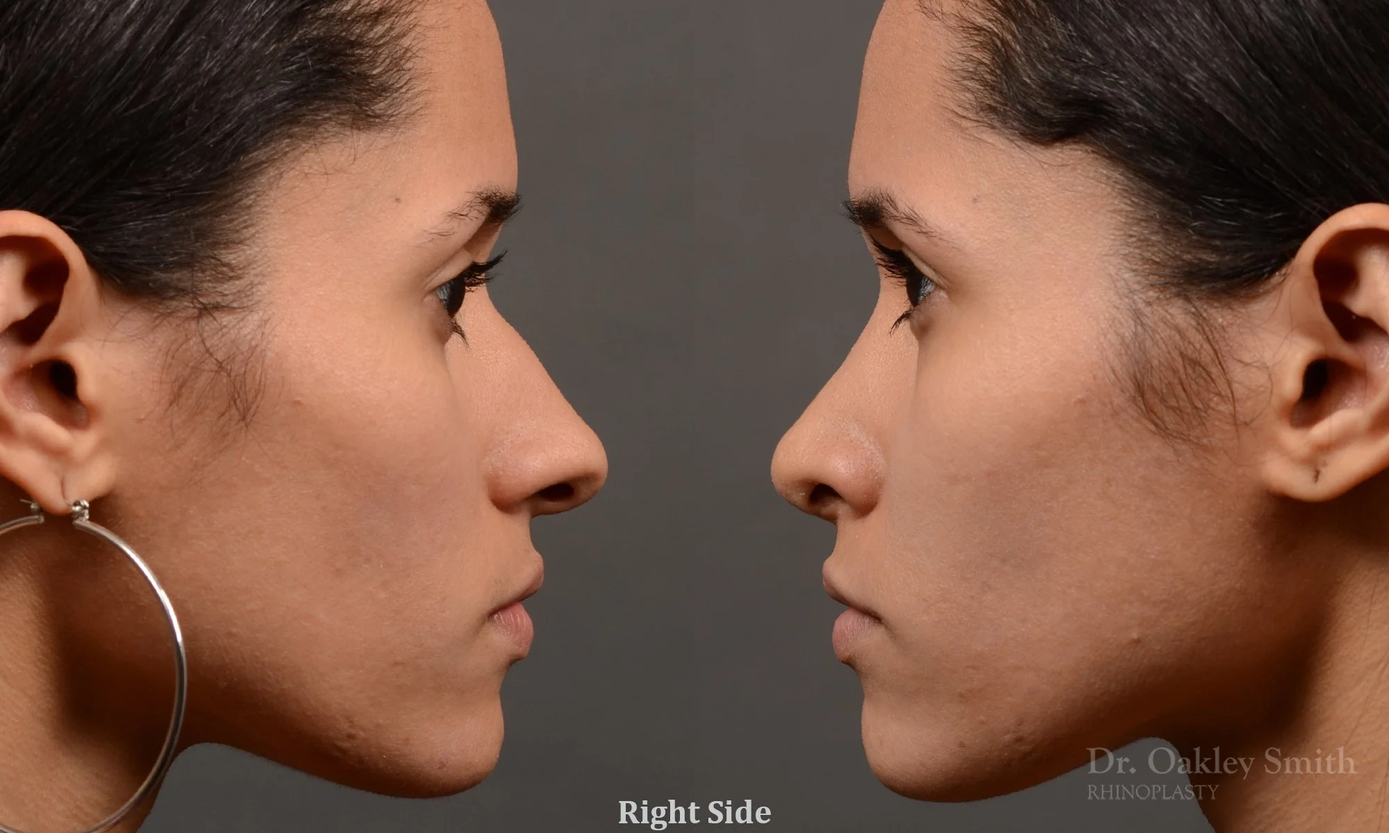 330: Female, Ethnic Rhinoplasty, Dorsal Hump, Tip Refinement