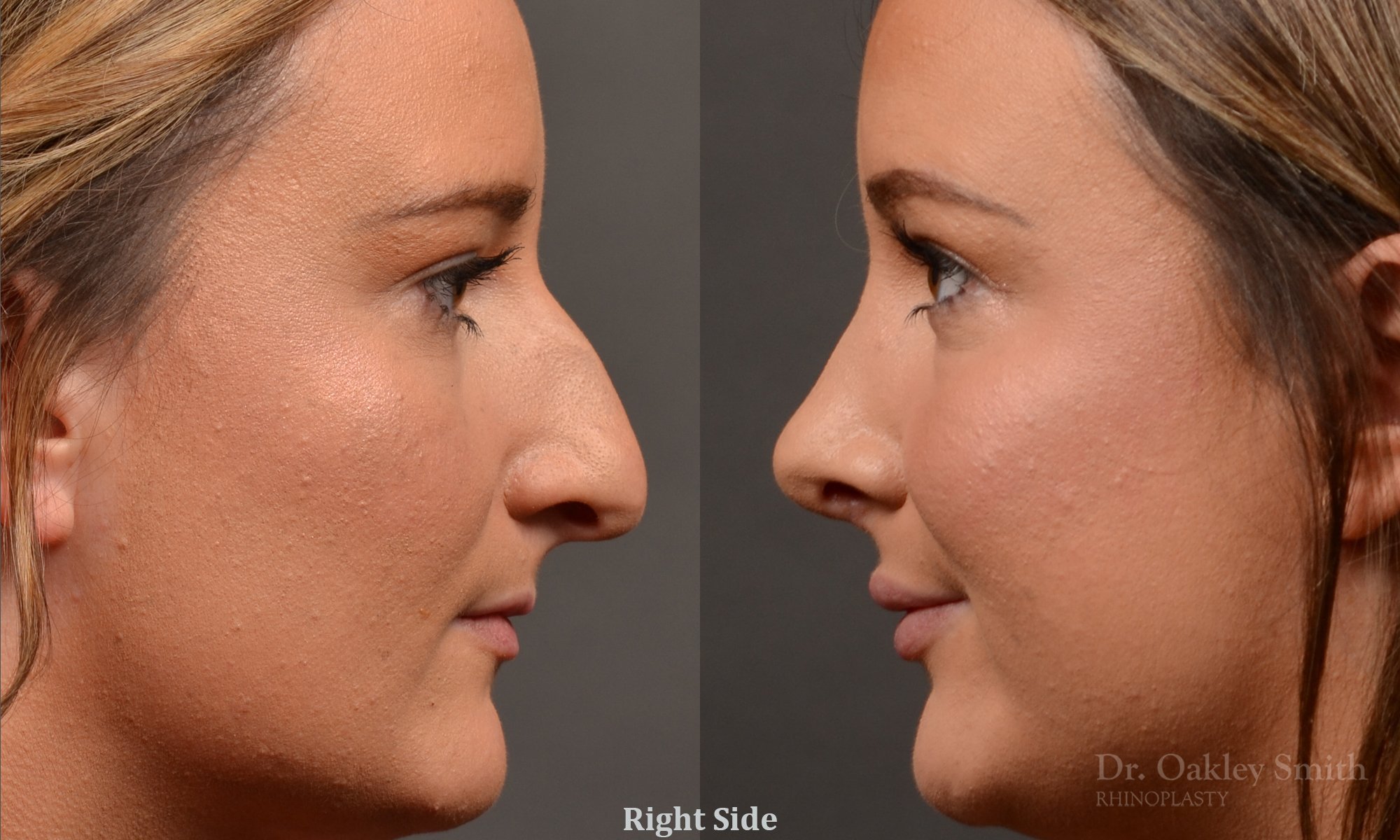 478: Female, Ethnic Rhinoplasty, Dorsal Hump, Tip Raised