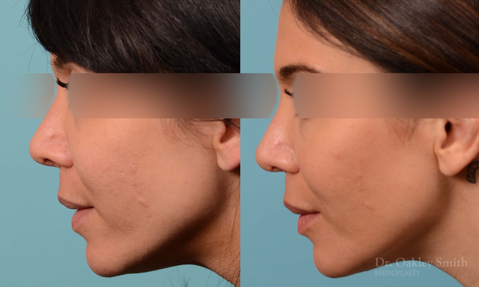 219E-rhinoplasty-toronto-dr-oakley-smith-curved-bridge-raised-tip-rotation-big-nose-nose-job-1.jpg