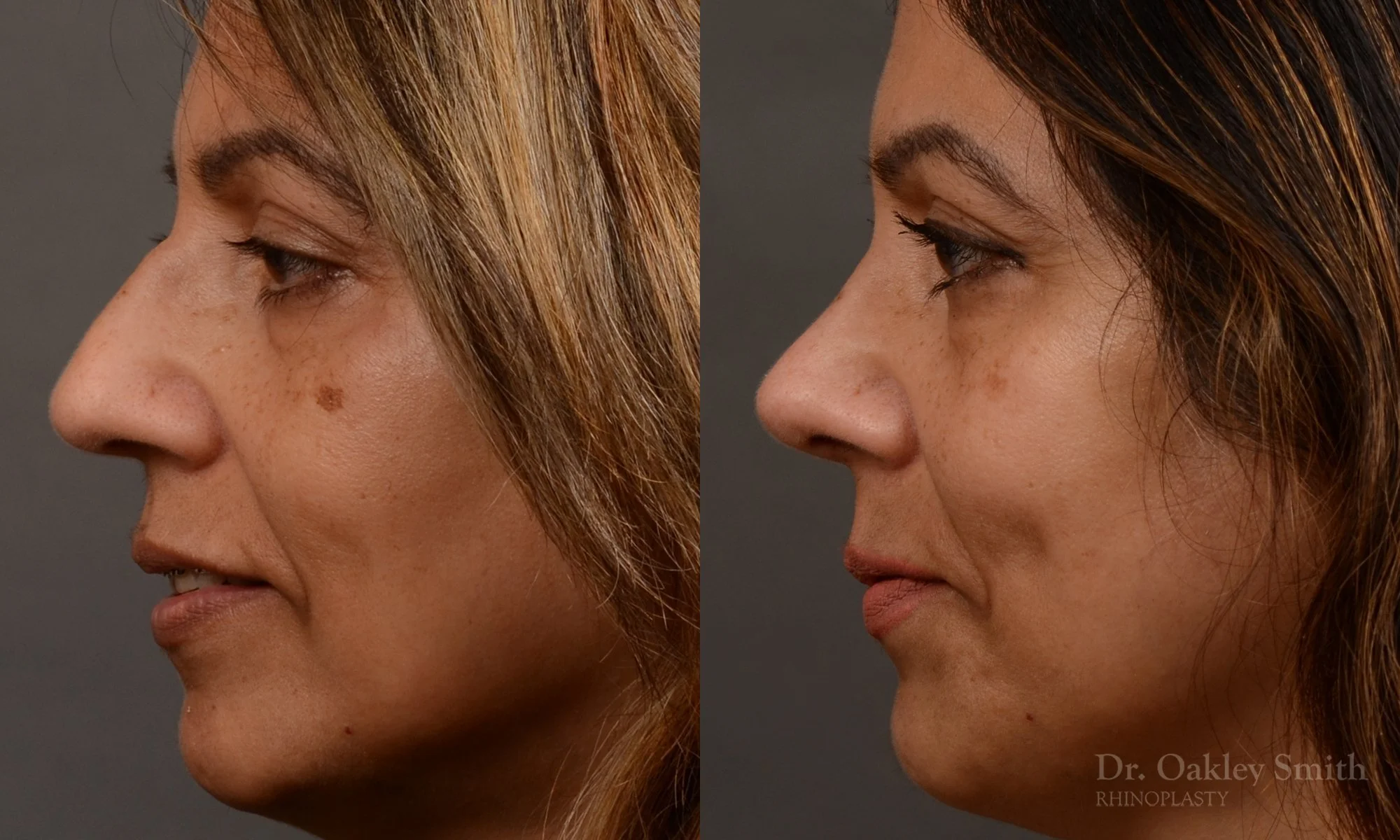 500E-rhinoplasty-dr-oakley-smith-toronto-top-surgeon-nose-job.jpg