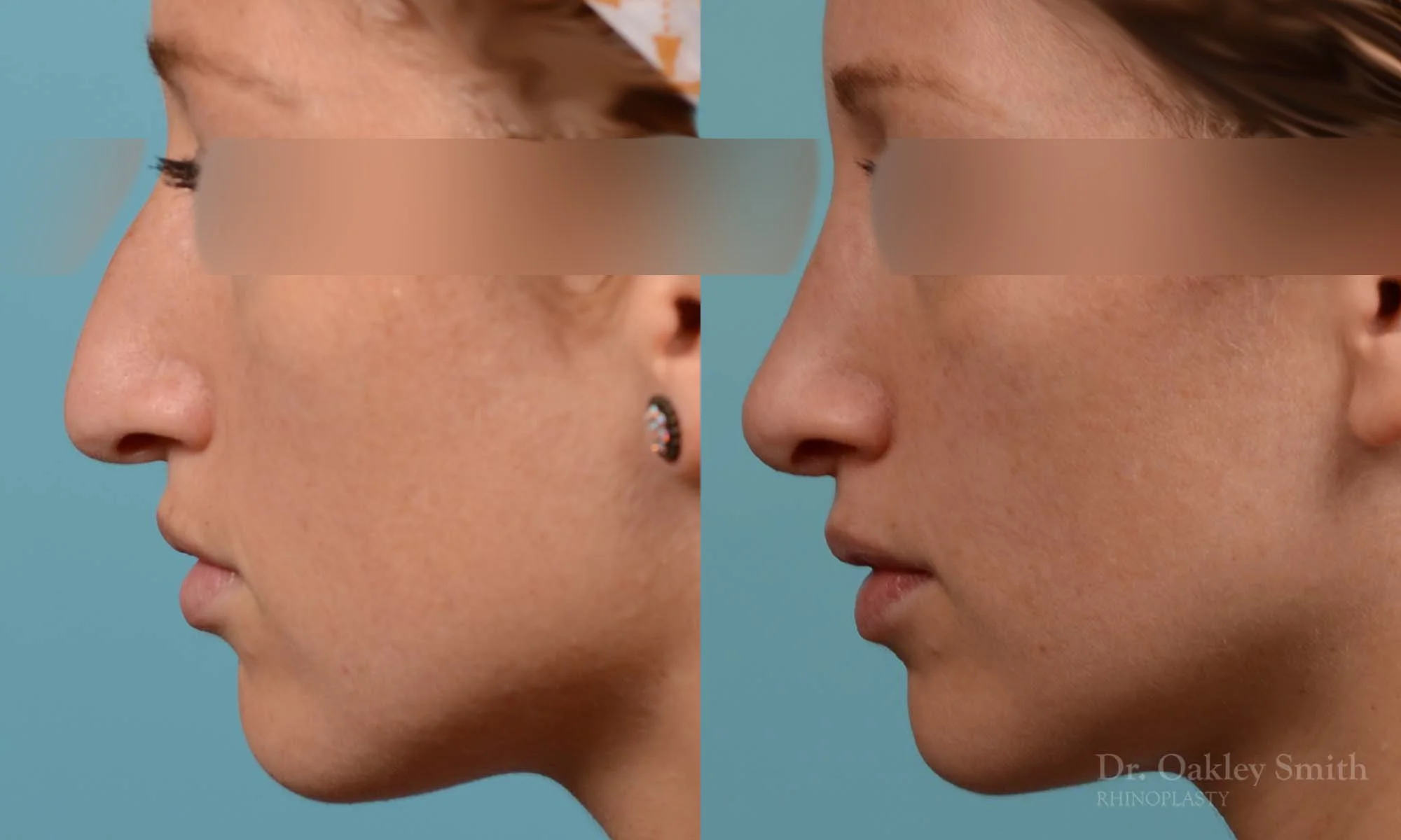 255E-rhinoplasty-dr-oakley-smith-toronto-female-nose-job.jpg