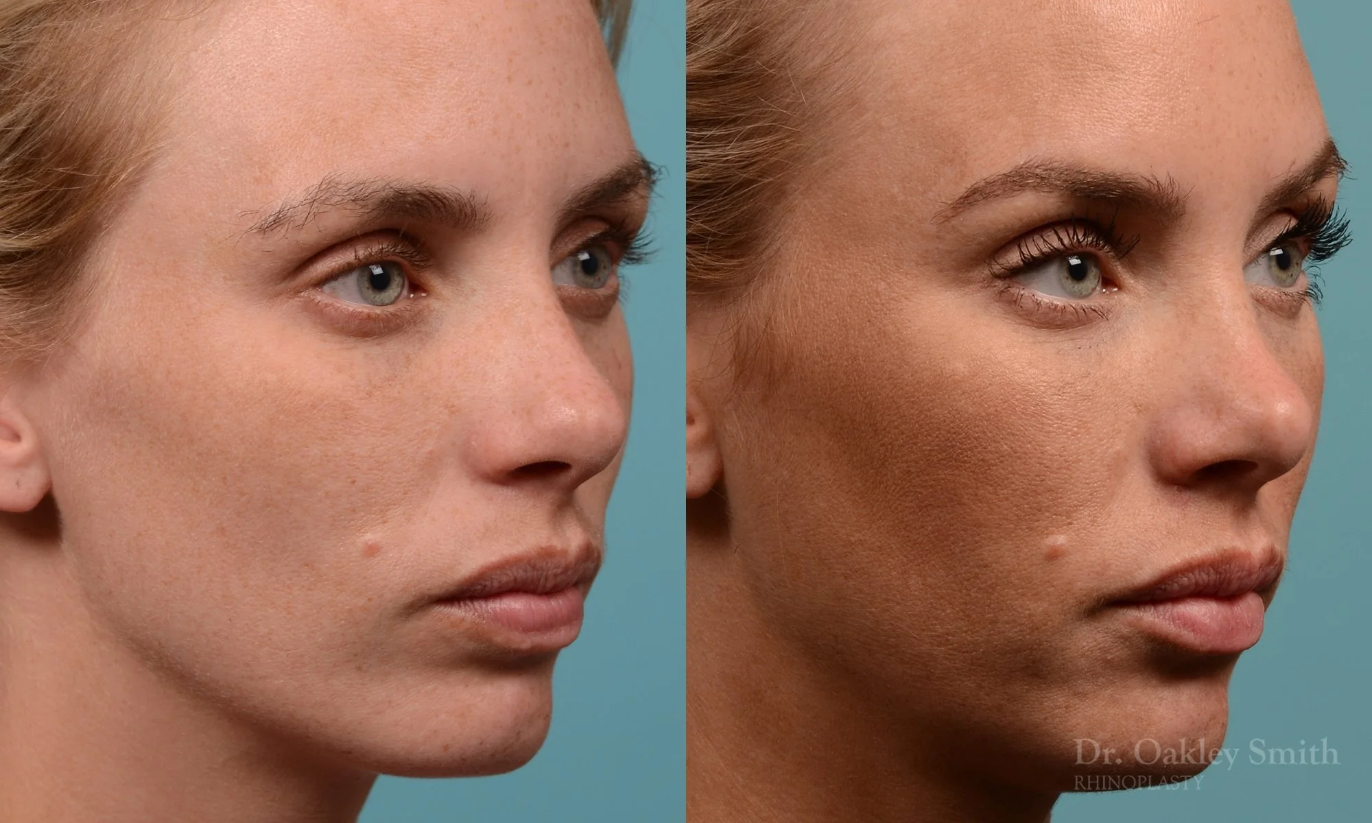 284B-rhinoplasty-dr-oakley-smith-toronto-nose-job.jpg