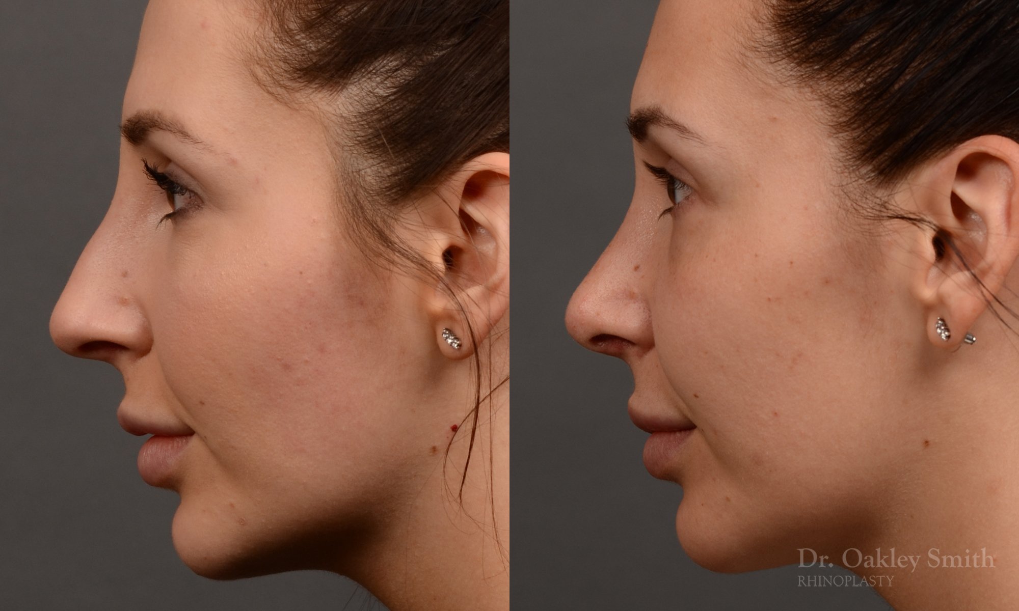 294E-rhinoplasty-dr-oakley-smith-toronto-nose-job.jpg