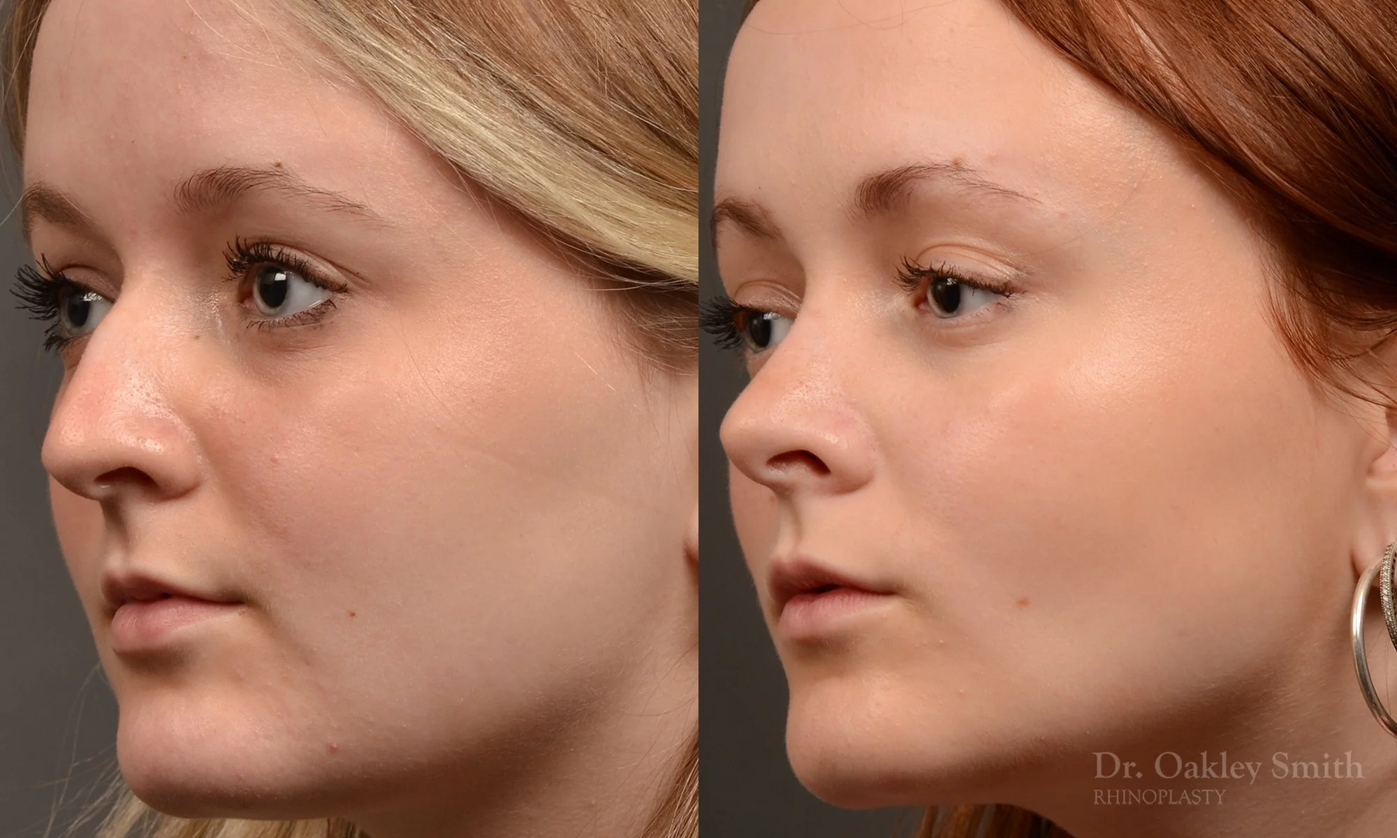 475D-rhinoplasty-dr-oakley-smith-toronto-top-surgeon-nose-job.jpg
