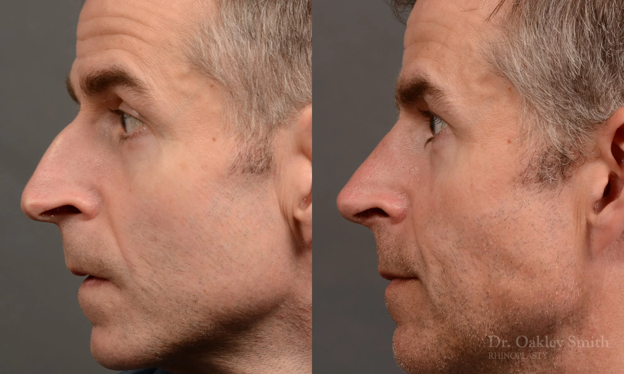 535E-male-rhinoplasty-dr-oakley-smith-toronto-top-surgeon-nose-job.jpg