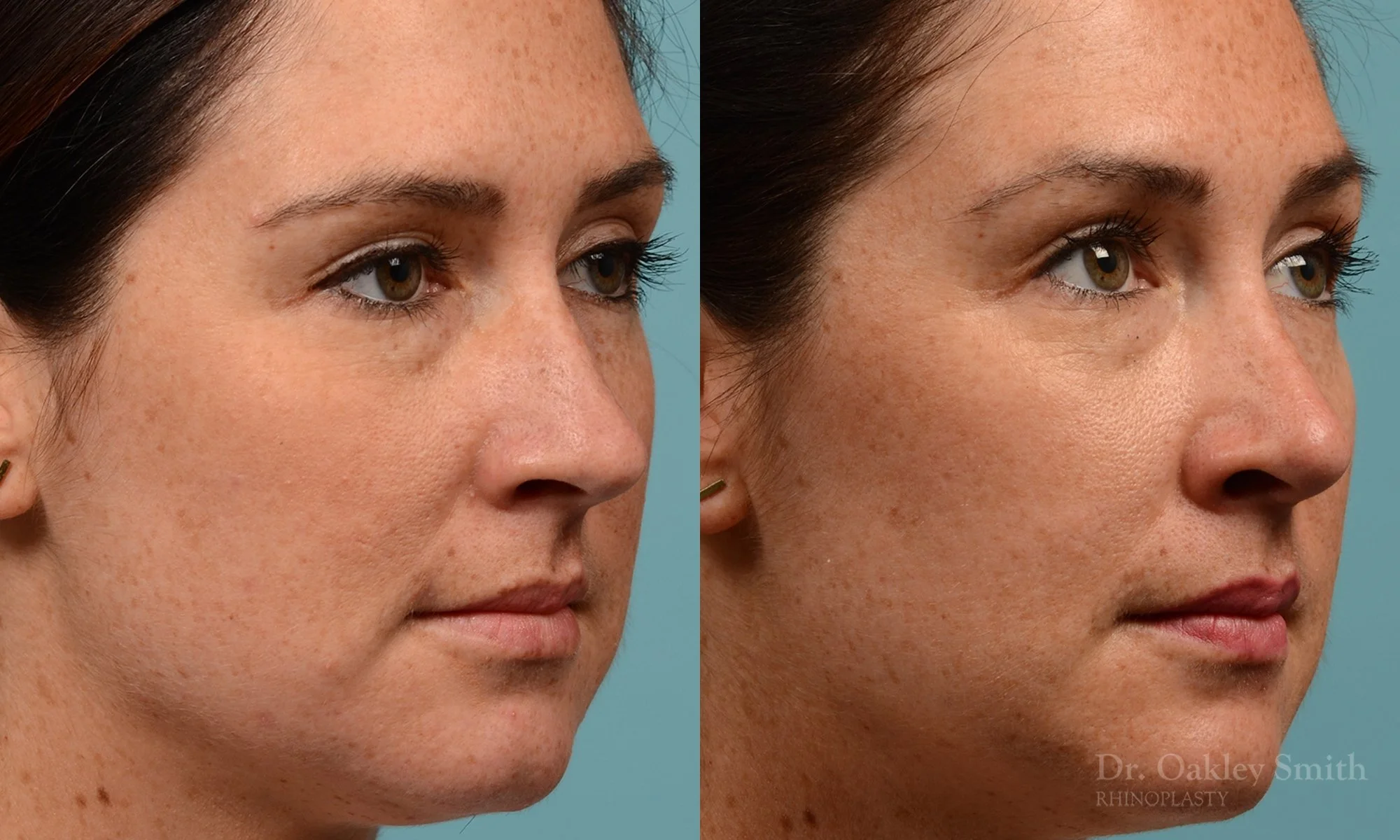 302B-rhinoplasty-dr-oakley-smith-toronto-nose-job.jpg
