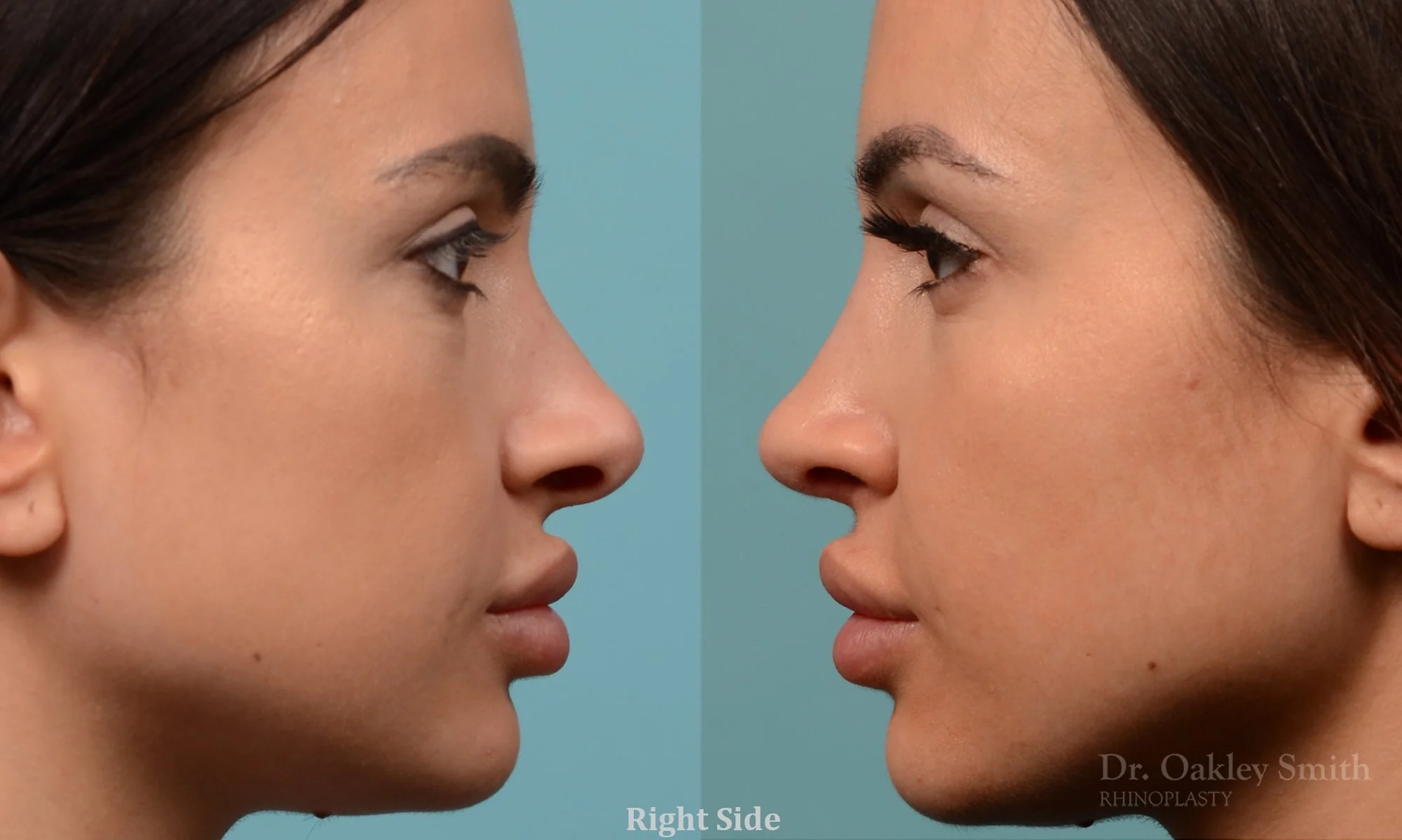 259C-rhinoplasty-dr-oakley-smith-toronto-nose-job.jpg