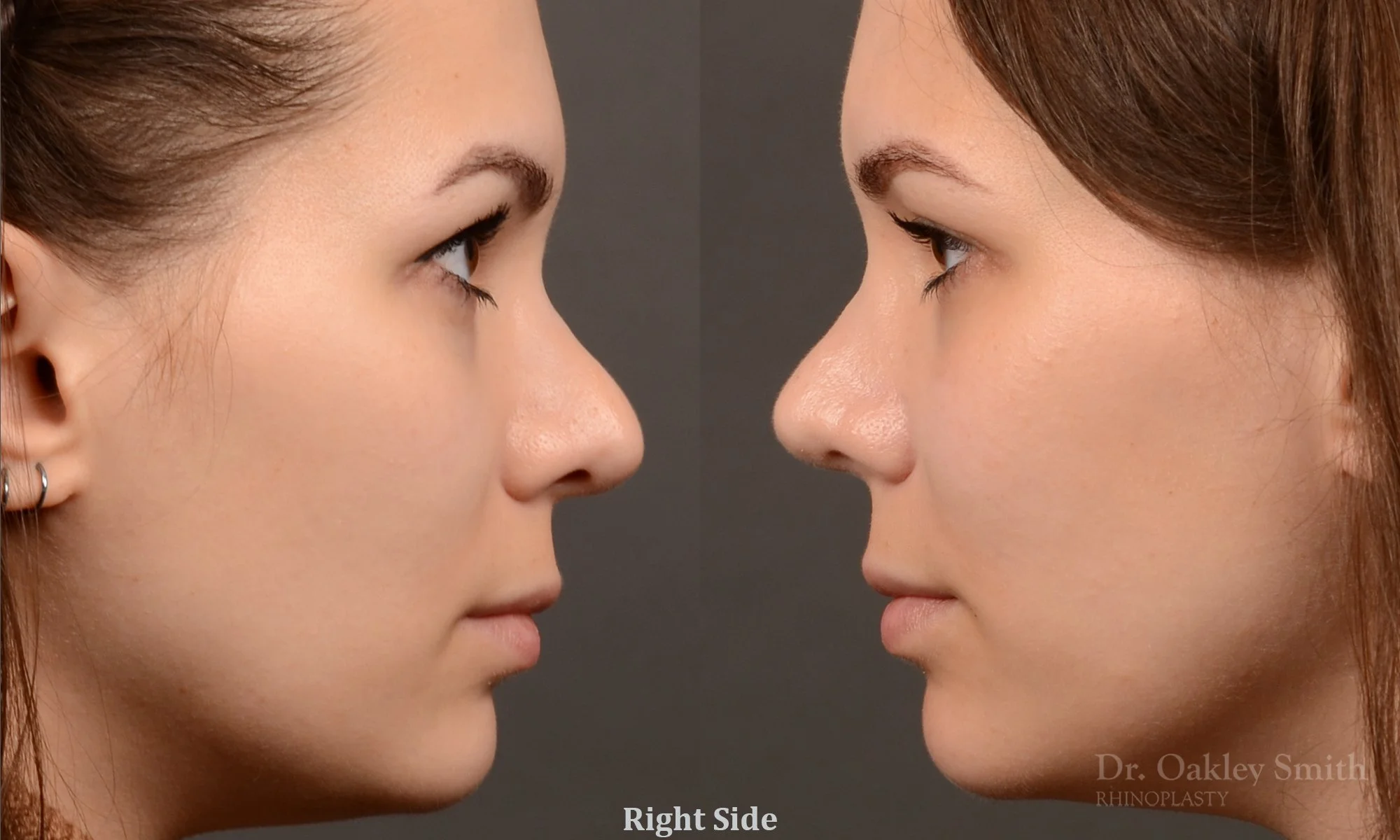 542C-rhinoplasty-before-and-after-nose-job-toronto-Dr.-Oakley-Smith.jpg