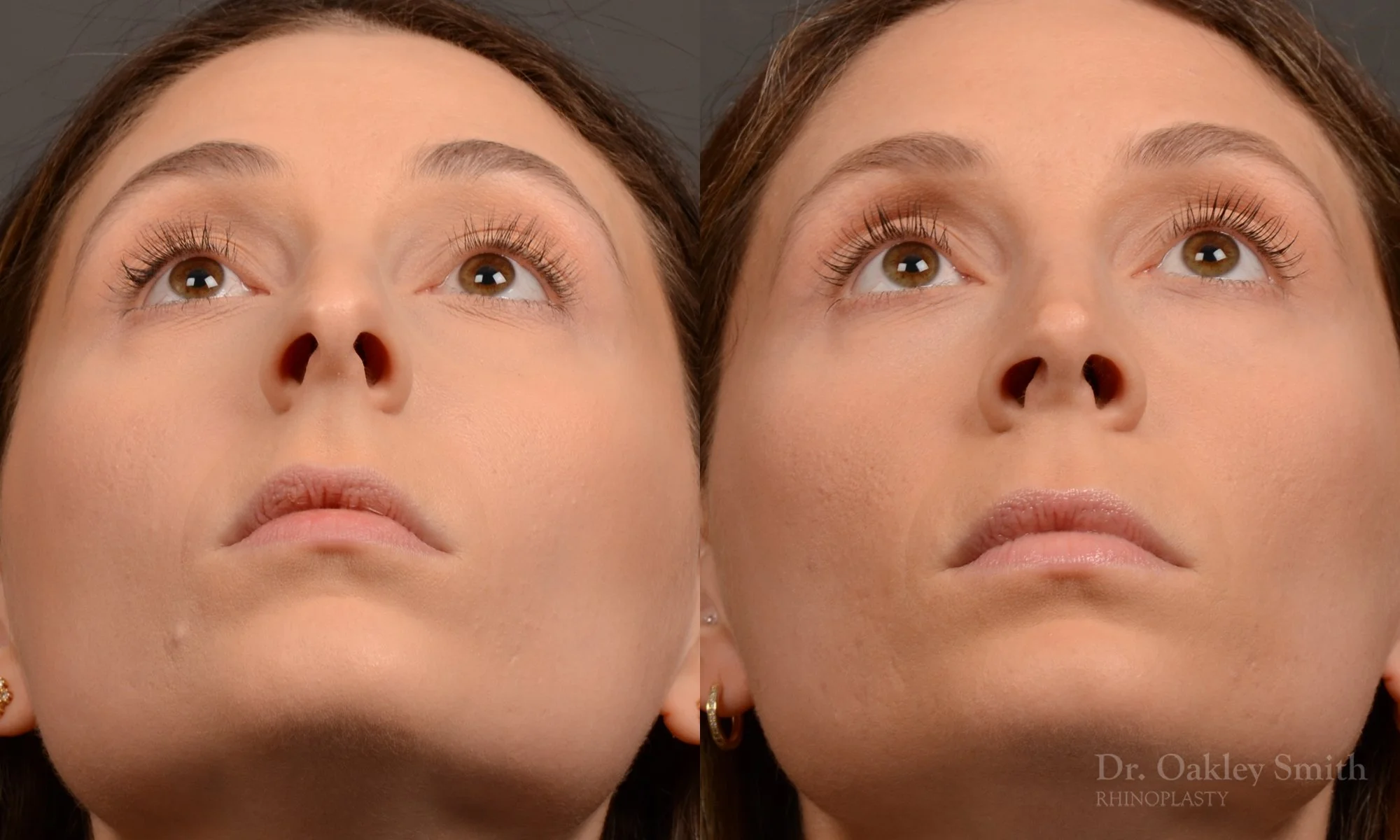 541F-rhinoplasty-dr-oakley-smith-toronto-nose-job.jpg
