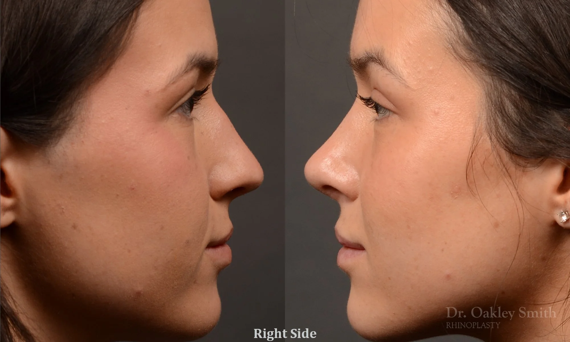 549C-rhinoplasty-nose-job-toronto-nose-surgeon-dr-oakley-smith.jpg