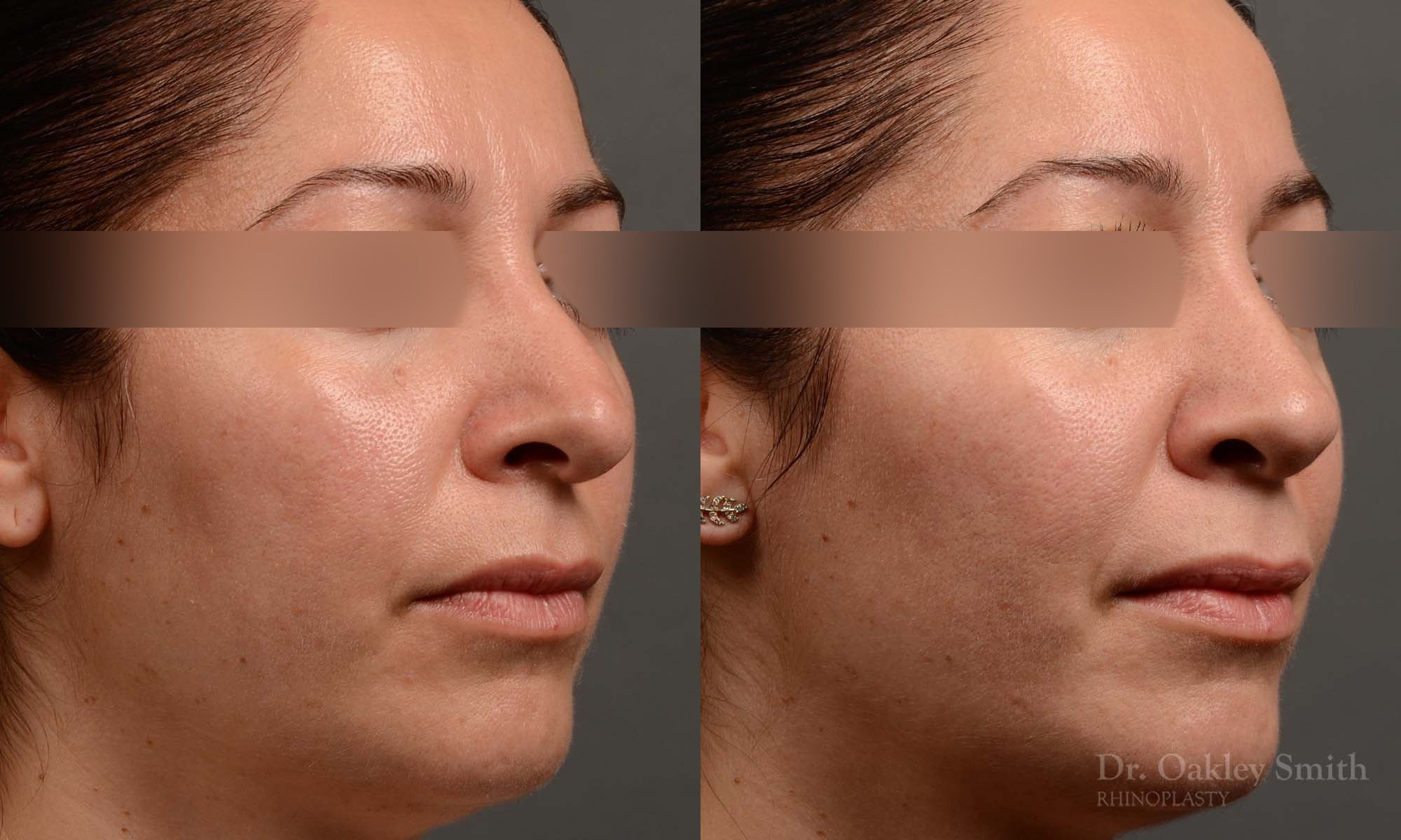331B-rhinoplasty-dr-oakley-smith-toronto-nose-job.jpg