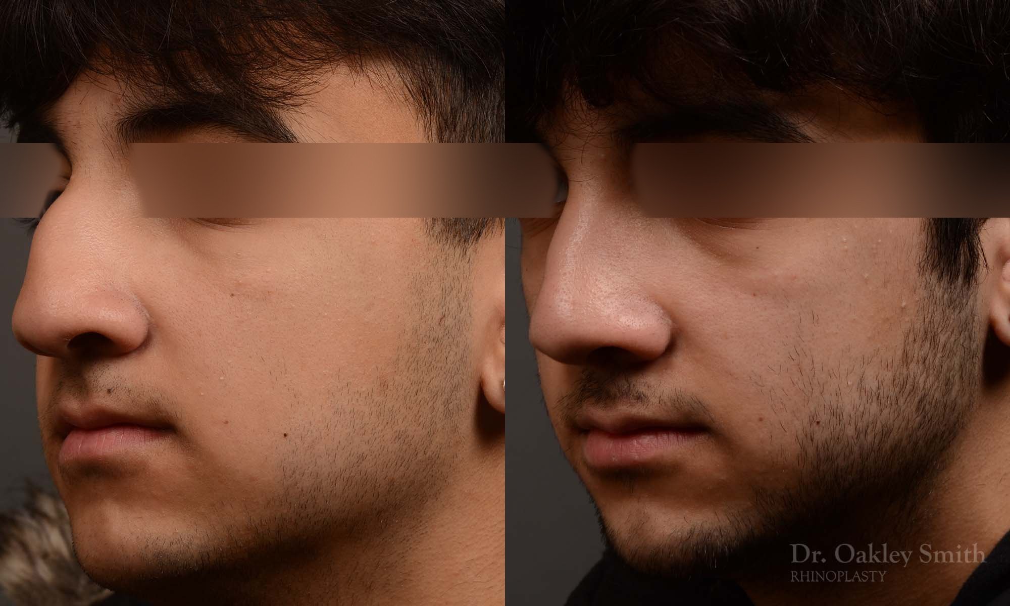 520D-male-rhinoplasty-dr-oakley-smith-toronto-top-surgeon-nose-job.jpg