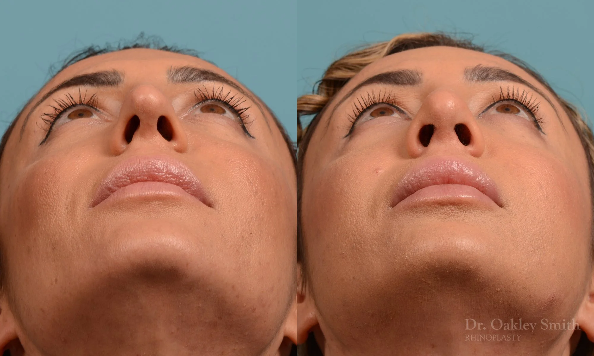 338F-rhinoplasty-dr-oakley-smith-toronto-nose-job.jpg