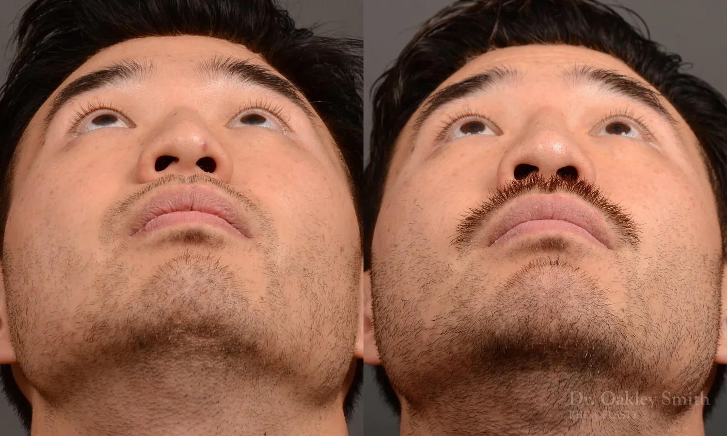 552F-rhinoplasty-filler-nose-job-toronto-nose-surgeon-dr-oakley-smith.webp