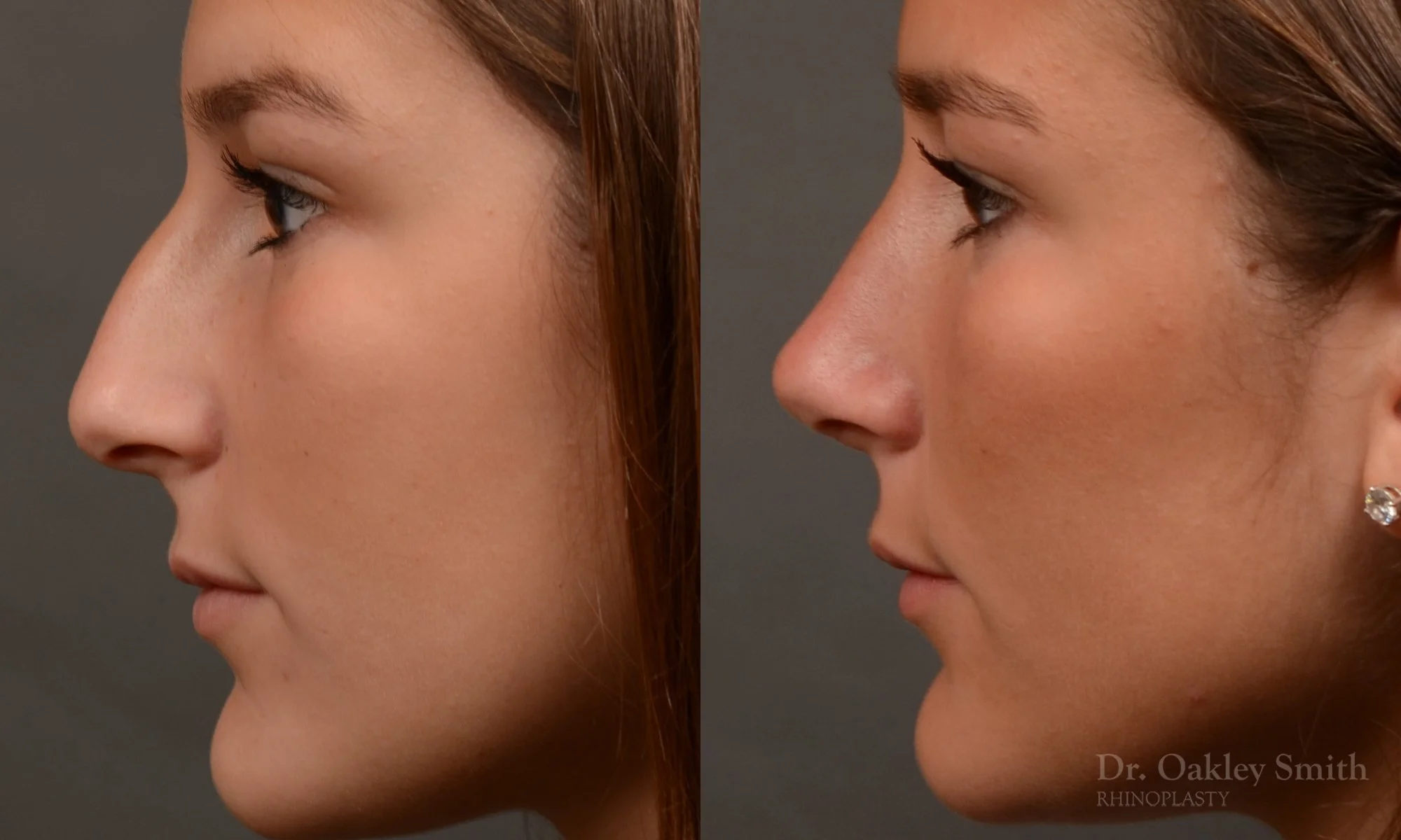 517E-rhinoplasty-dr-oakley-smith-toronto-top-surgeon-nose-job.jpg