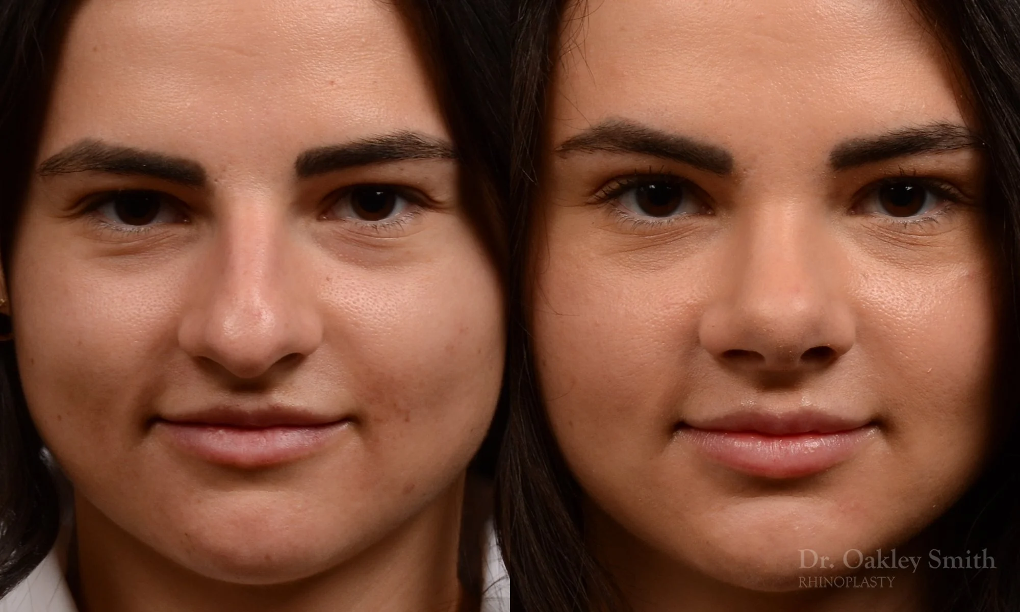509A-rhinoplasty-dr-oakley-smith-toronto-top-surgeon-nose-job.jpg