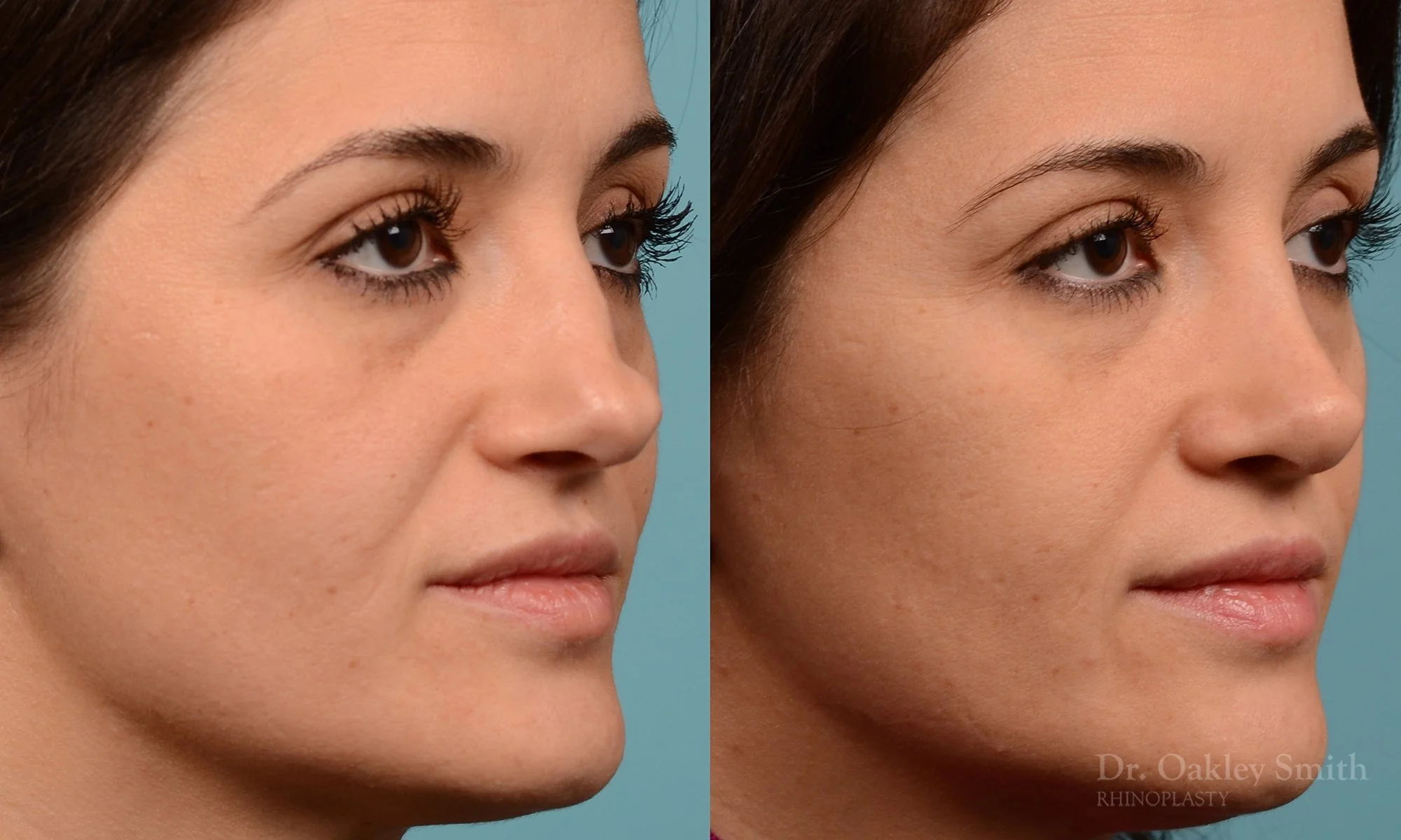 234B-nose-job-nose-reduction-rhinoplasty-pointy-nose-curved-nose-dr-oakley-smith-toronto (1).jpg