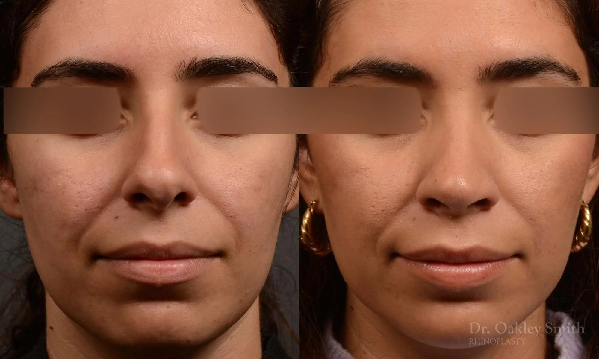 488A-rrhinoplasty-dr-oakley-smith-toronto-top-surgeon-nose-job.jpg