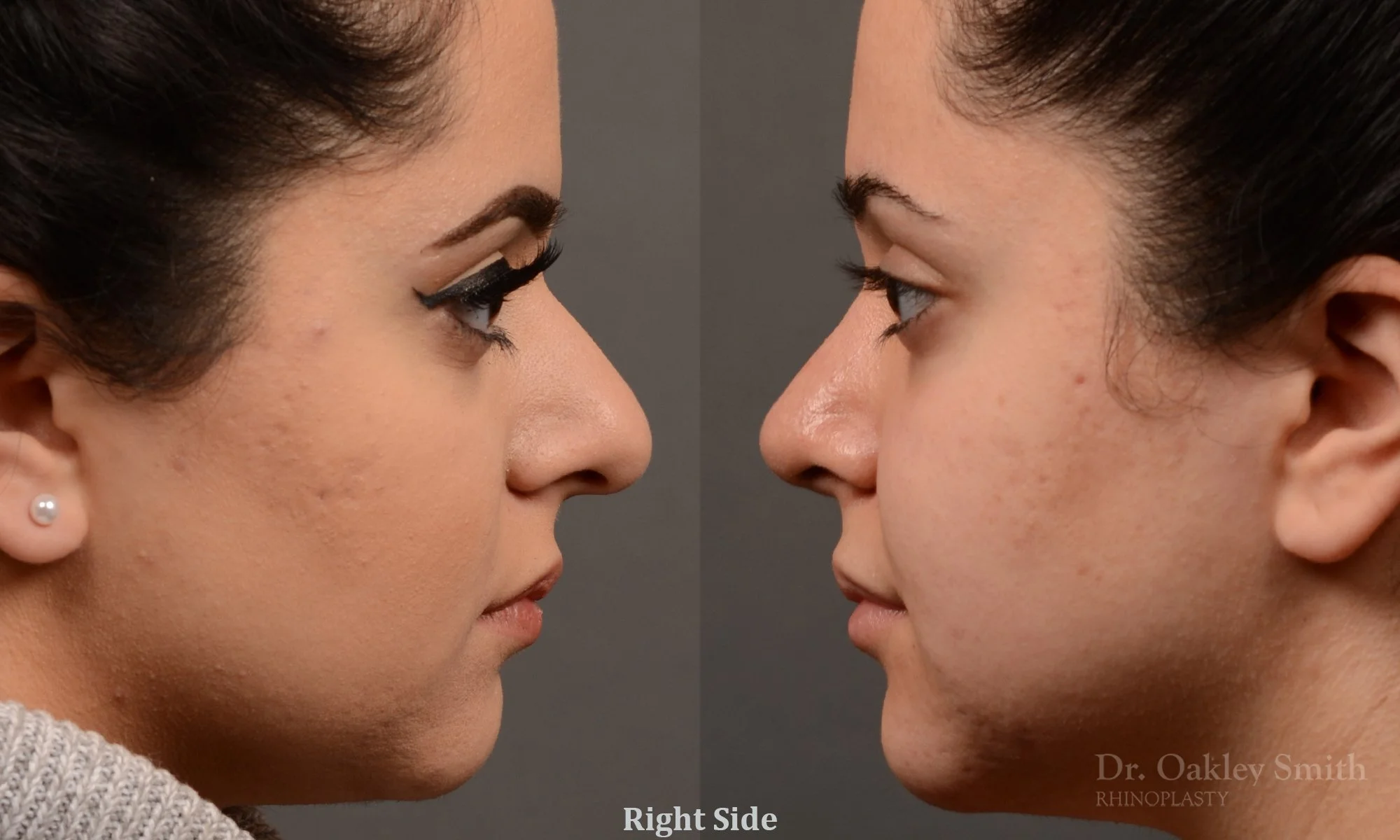 304C-rhinoplasty-dr-oakley-smith-toronto-nose-job.jpg