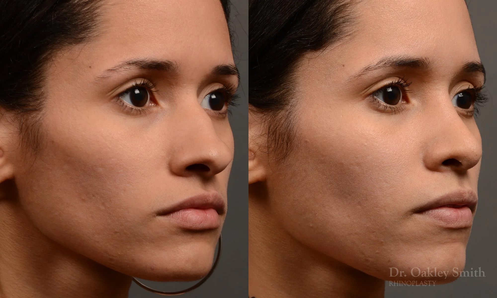 330B-rhinoplasty-dr-oakley-smith-toronto-nose-job.jpg