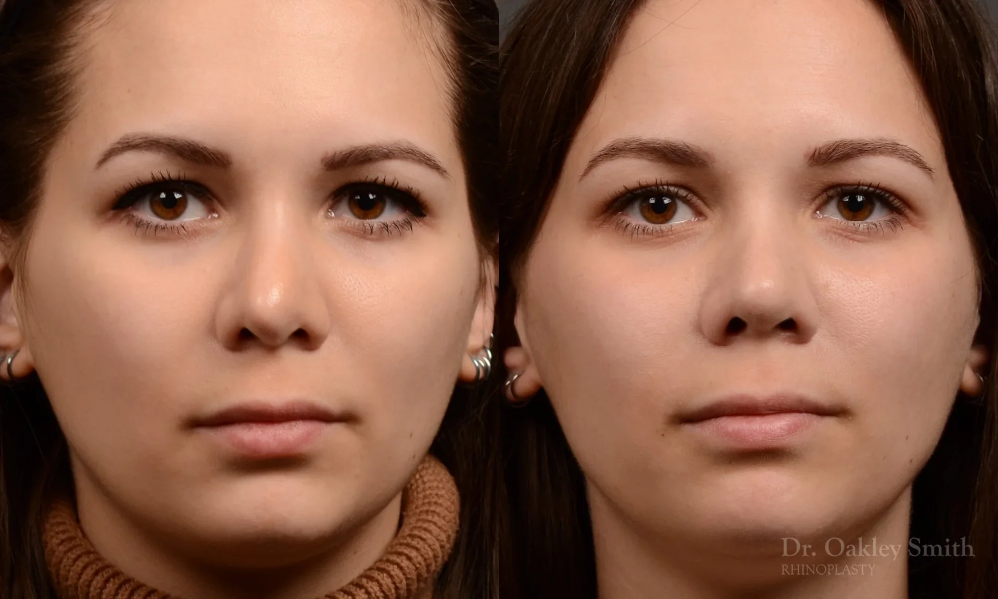 542: Female, Revision Rhinoplasty, Bridge and Tip Work, Crooked