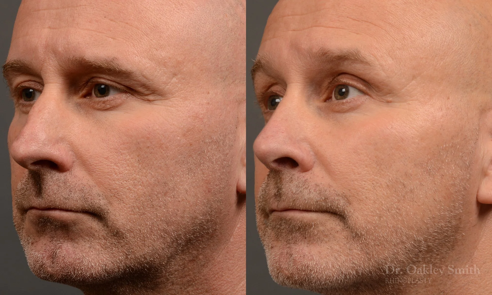 493D-male-rhinoplasty-dr-oakley-smith-toronto-top-surgeon-nose-job.jpg