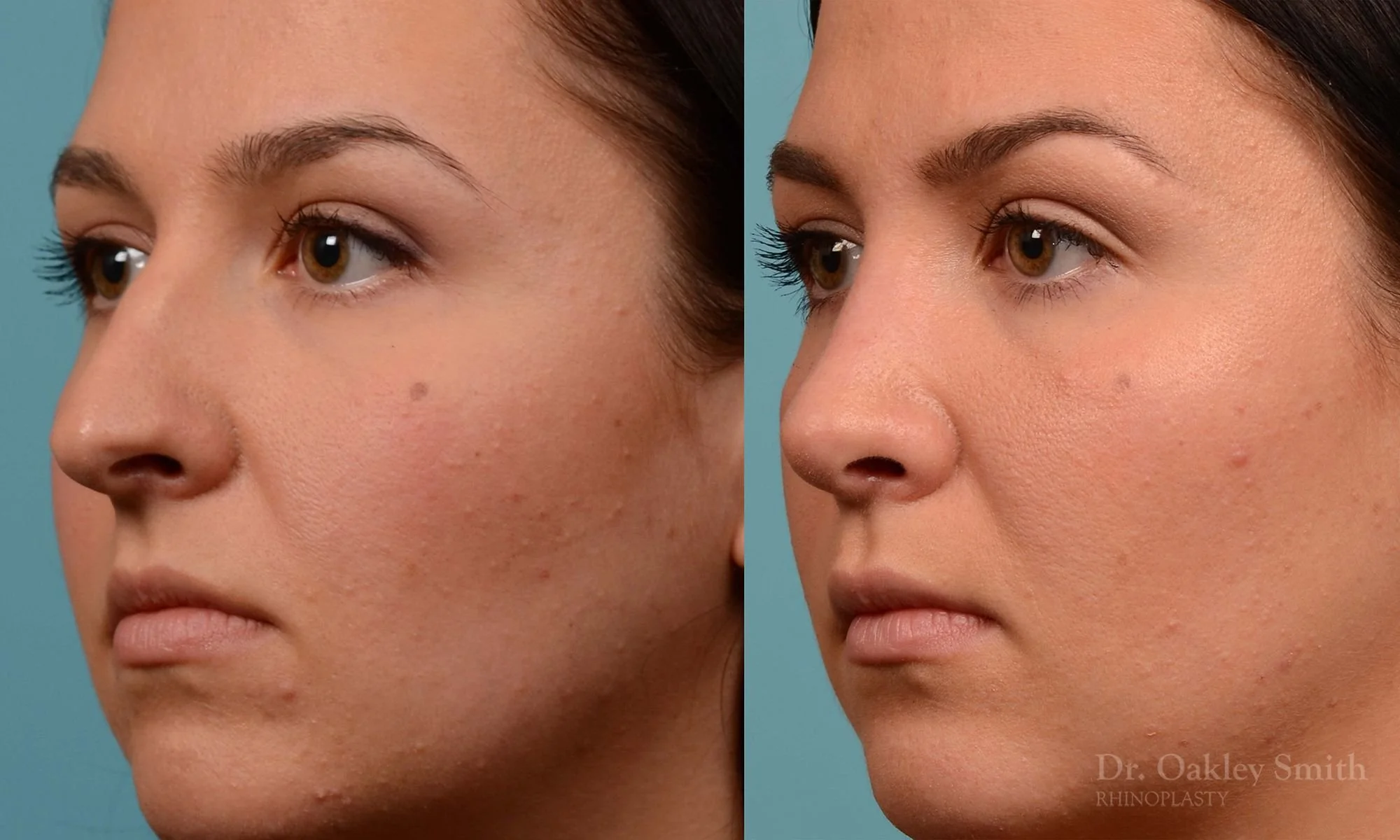 209D-nose-job-curved-nose-straight-profile-deviated-septum-rhinoplasty-septoplasty-dr-oakley-smith-toronto-1.jpg