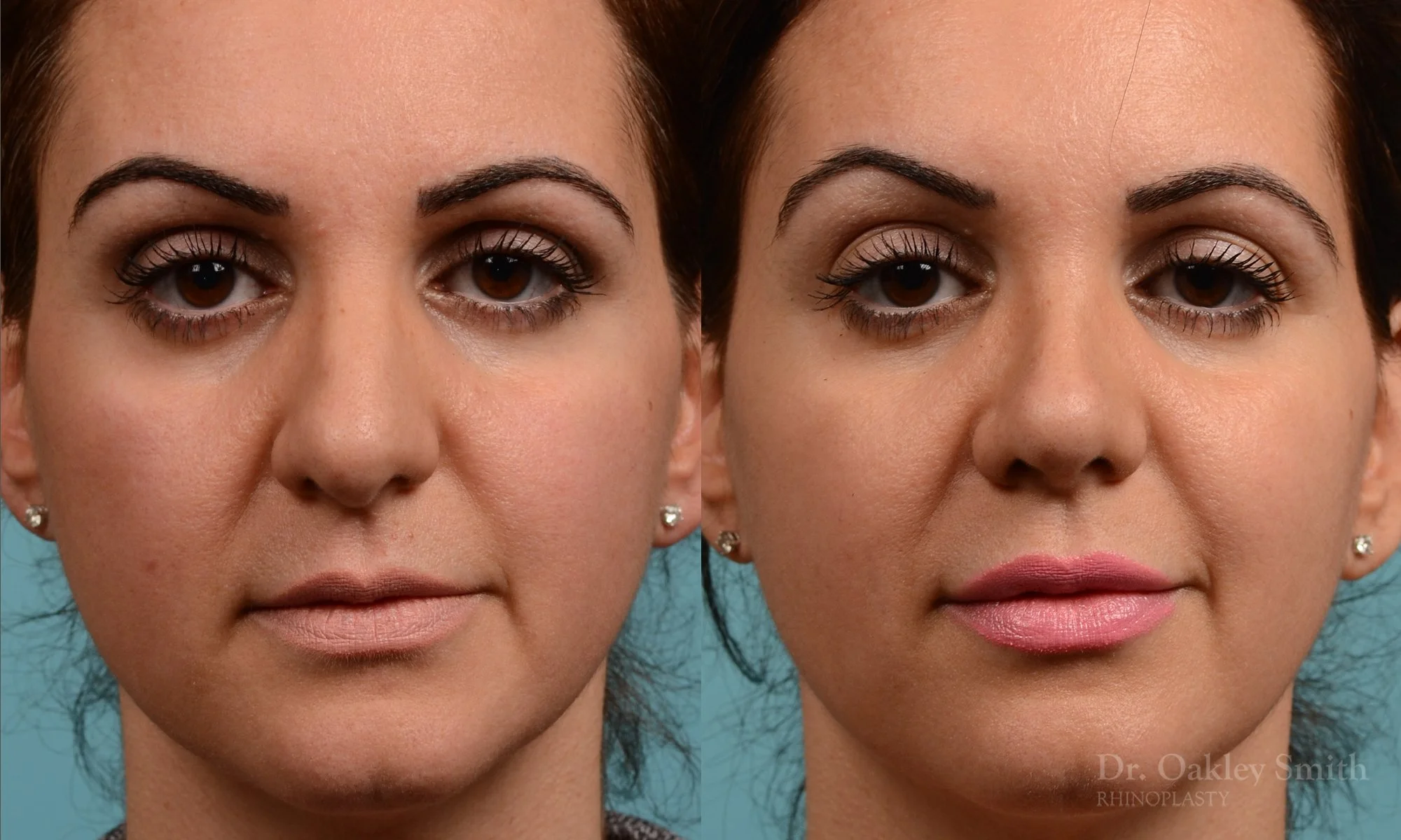 311A-rhinoplasty-dr-oakley-smith-toronto-nose-job.jpg