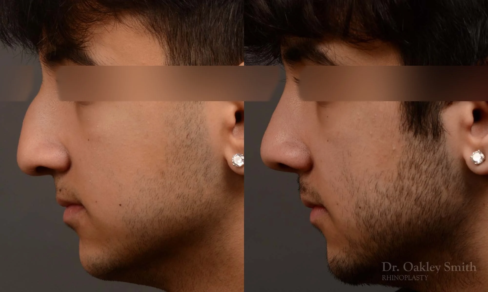 520E-male-rhinoplasty-dr-oakley-smith-toronto-top-surgeon-nose-job.jpg