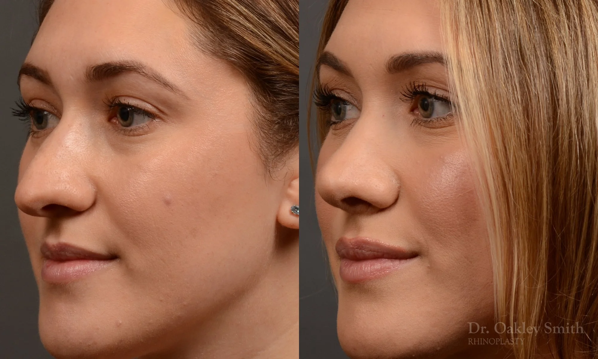 497D-rhinoplasty-dr-oakley-smith-toronto-top-surgeon-nose-job.jpg