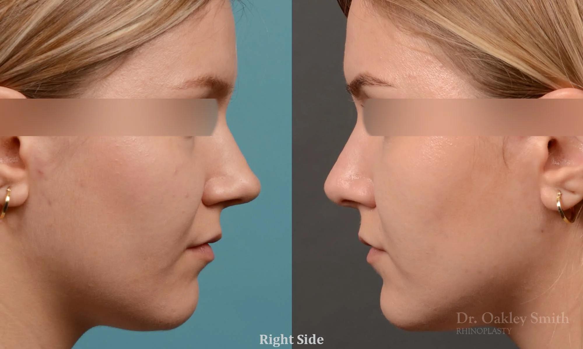 292C-rhinoplasty-dr-oakley-smith-toronto-nose-job.jpg