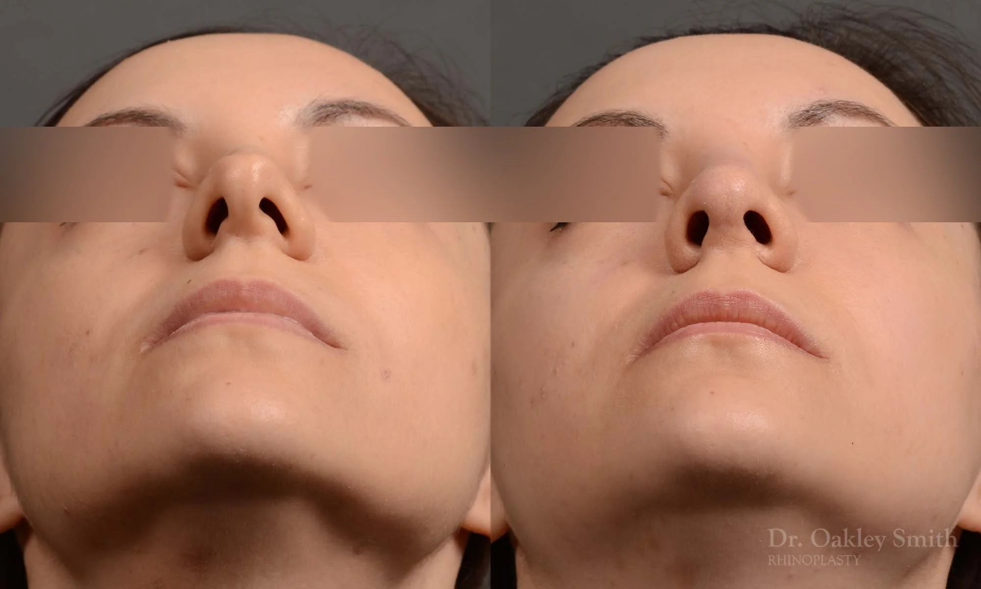 341F-rhinoplasty-dr-oakley-smith-toronto-nose-job.jpg