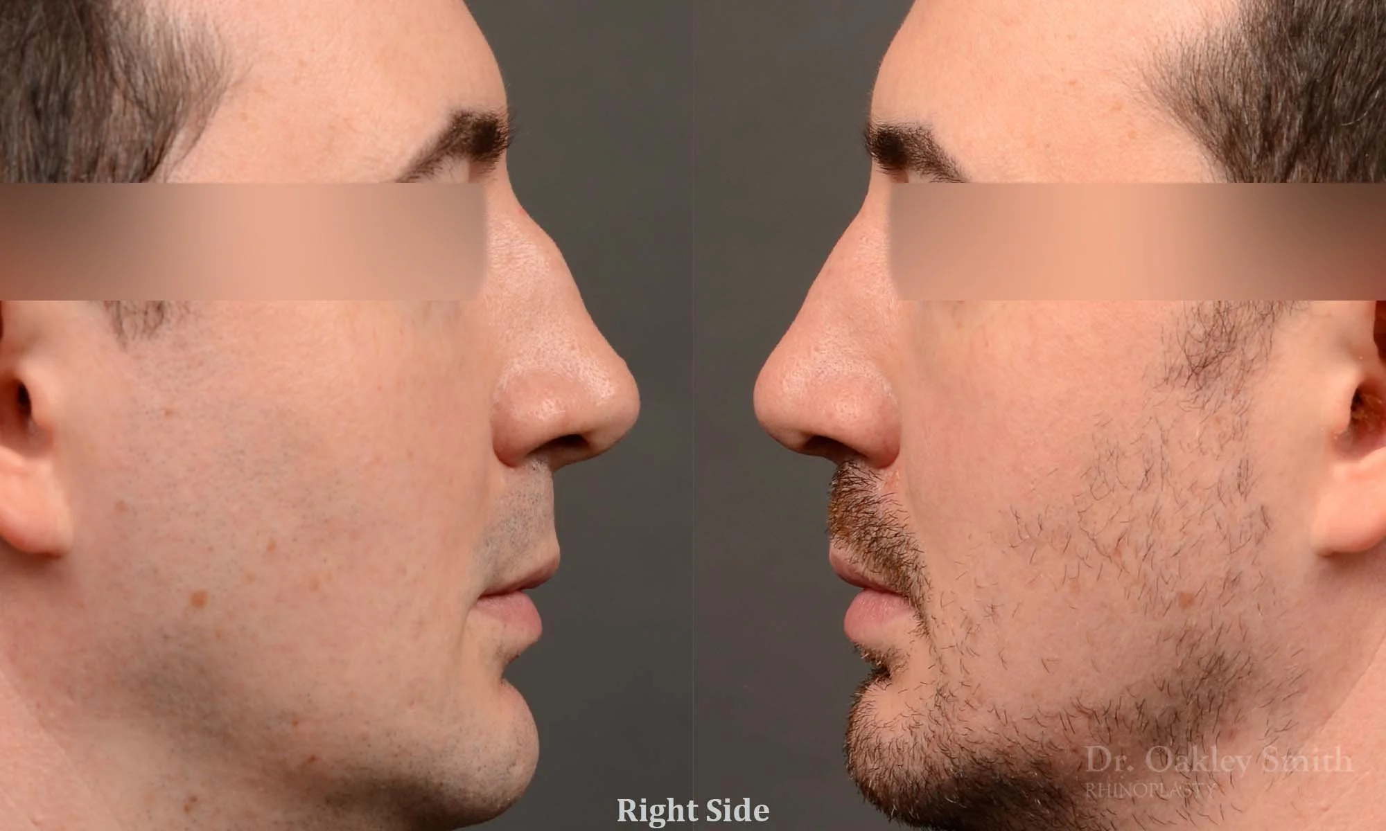 555C male rhinoplasty, nose job, toronto nose surgeon, dr oakley smith.jpg