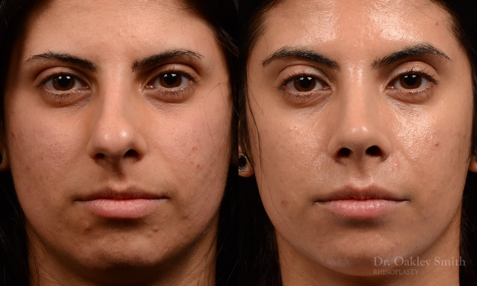 518A-rhinoplasty-dr-oakley-smith-toronto-top-surgeon-nose-job.jpg