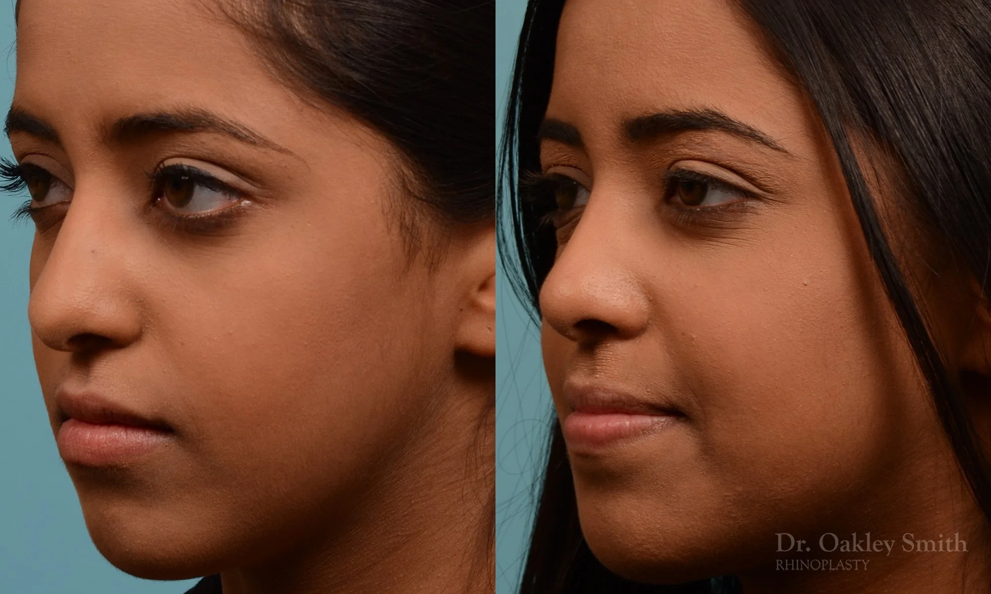 285D-rhinoplasty-dr-oakley-smith-toronto-nose-job.jpg