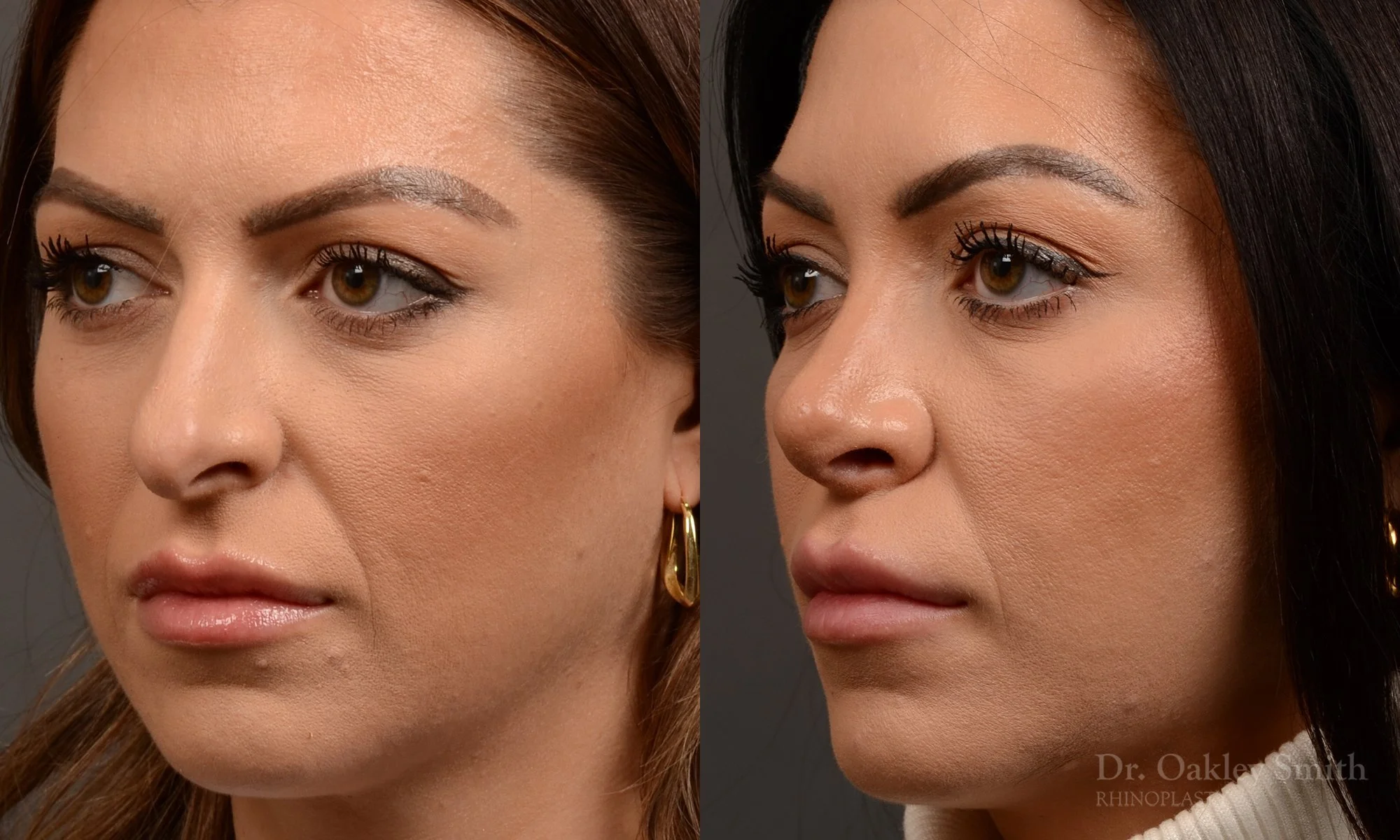 524D-rhinoplasty-dr-oakley-smith-toronto-top-surgeon-nose-job.jpg
