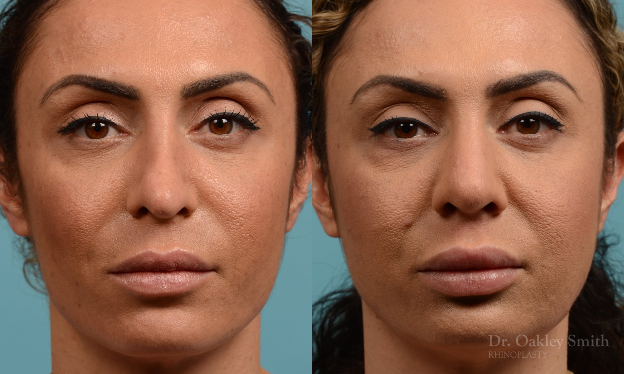 338A-rhinoplasty-dr-oakley-smith-toronto-nose-job.jpg