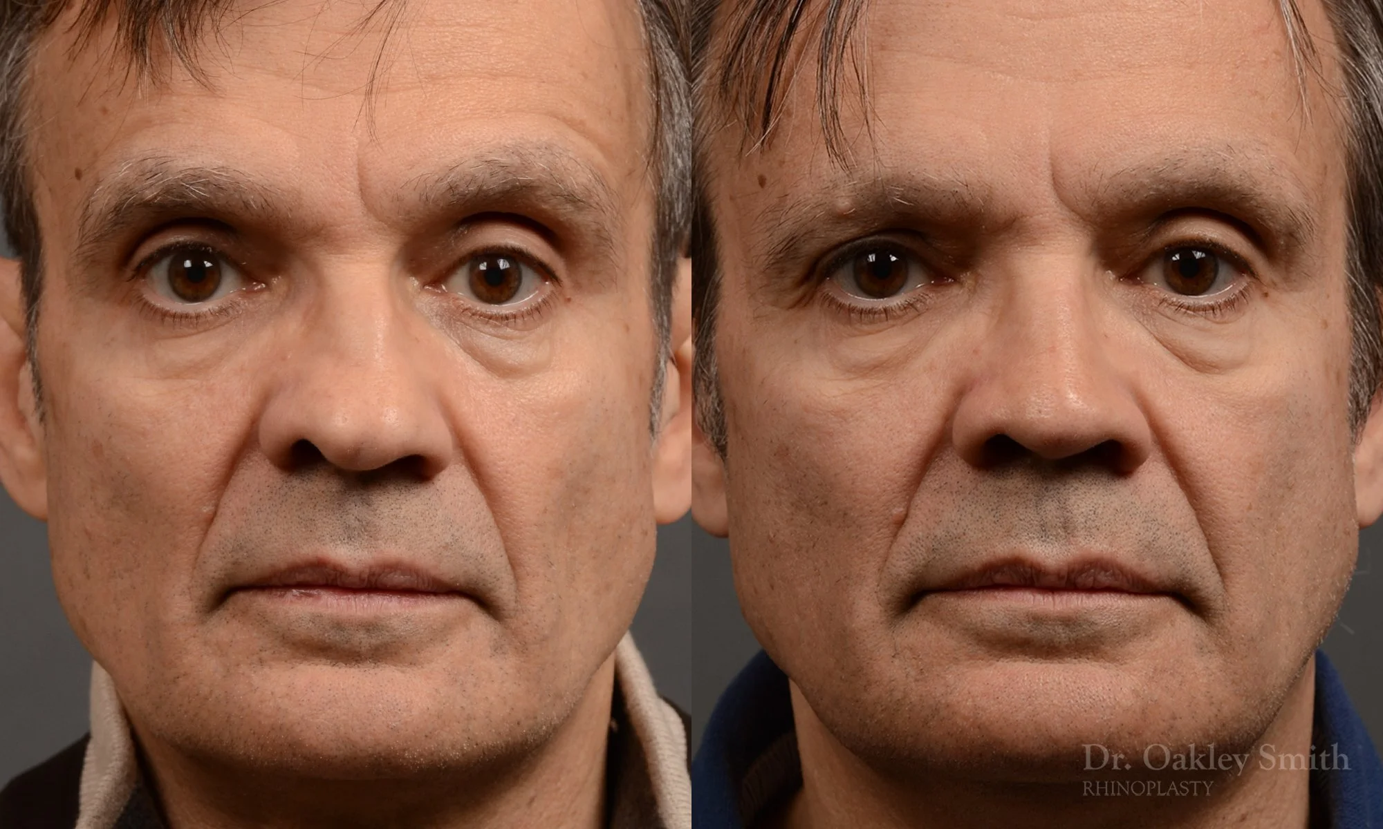 306.1A-rhinoplasty-dr-oakley-smith-toronto-nose-job.jpg