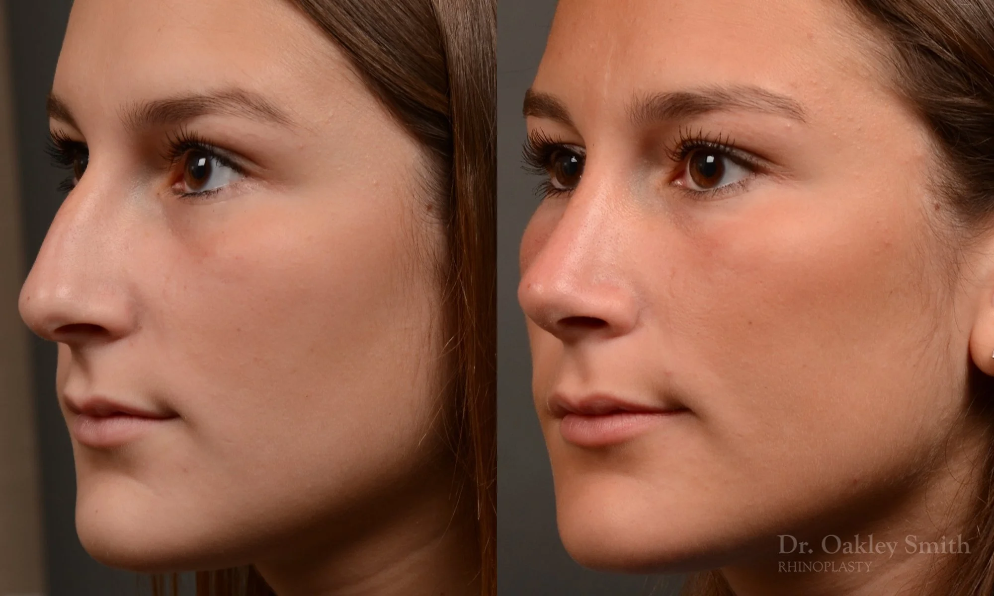 517D-rhinoplasty-dr-oakley-smith-toronto-top-surgeon-nose-job.jpg