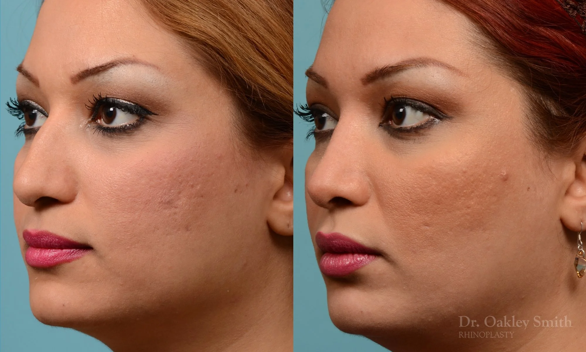 260D-rhinoplasty-dr-oakley-smith-toronto-nose-job.jpg