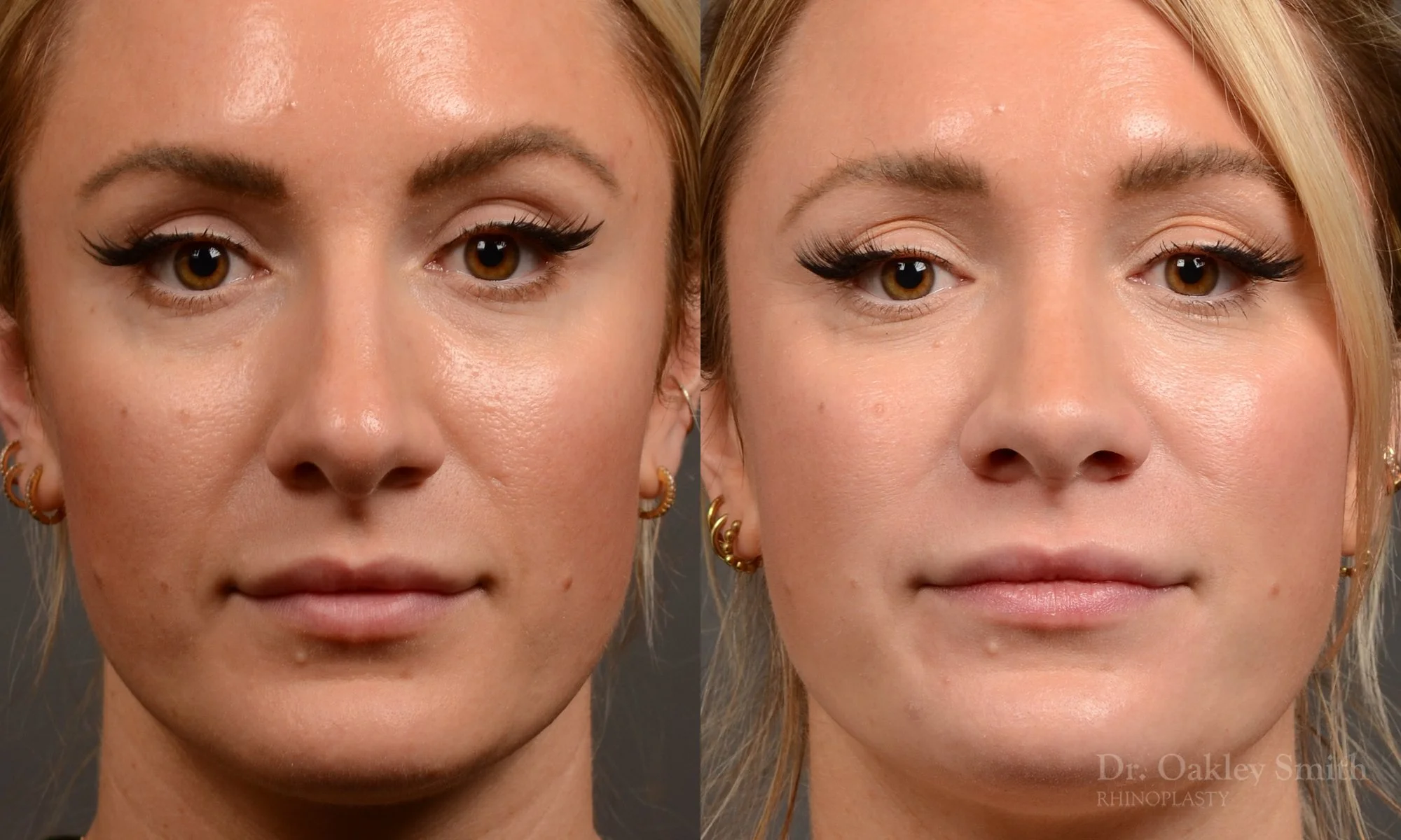 550A-rhinoplasty-nose-job-toronto-nose-surgeon-dr-oakley-smith.jpg