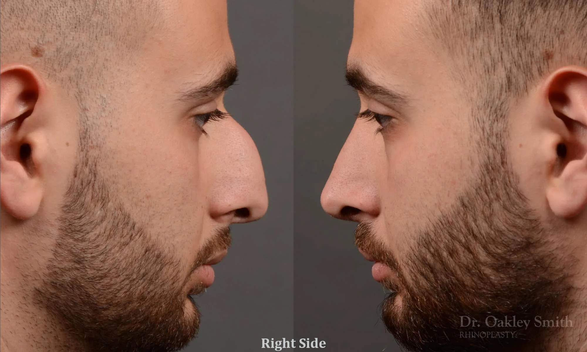 391C-rhinoplasty-dr-oakley-smith-toronto-nose-job.jpg