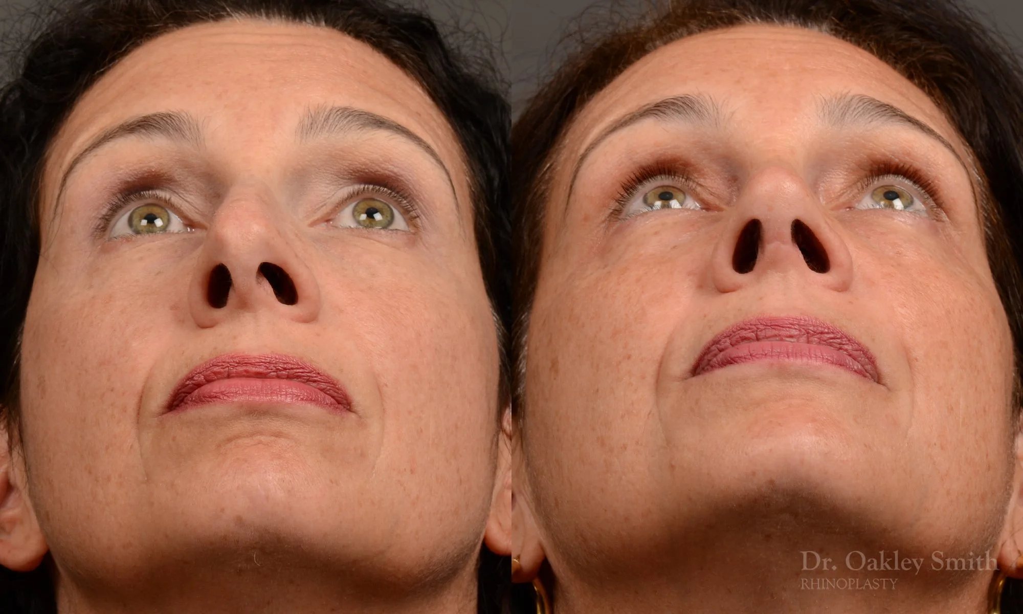 545F-rhinoplasty-nose-job-top-toronto-surgeon-dr.-oakley-smith.jpg